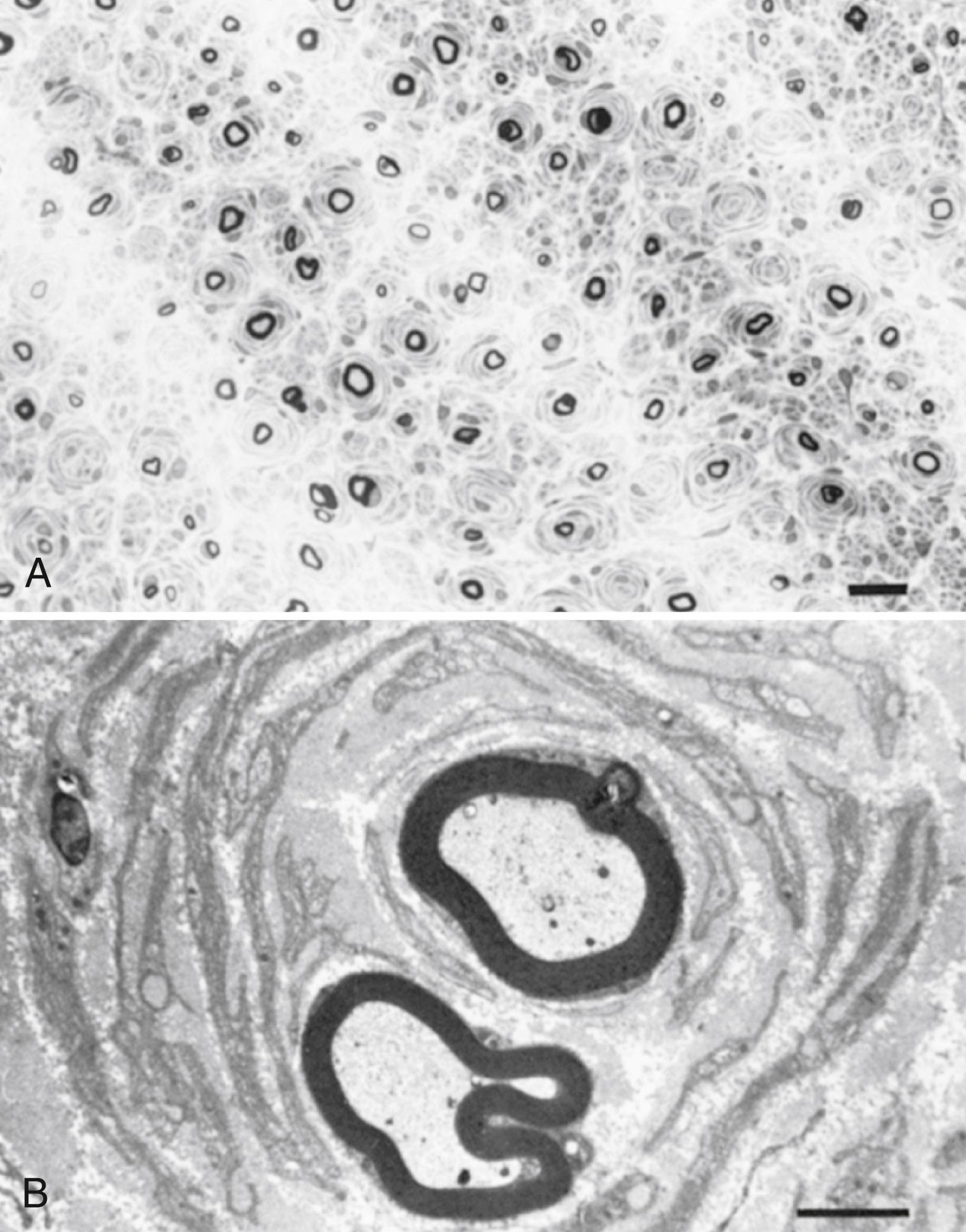 Fig. 106.9, Charcot-Marie-Tooth Type 1 Disease.