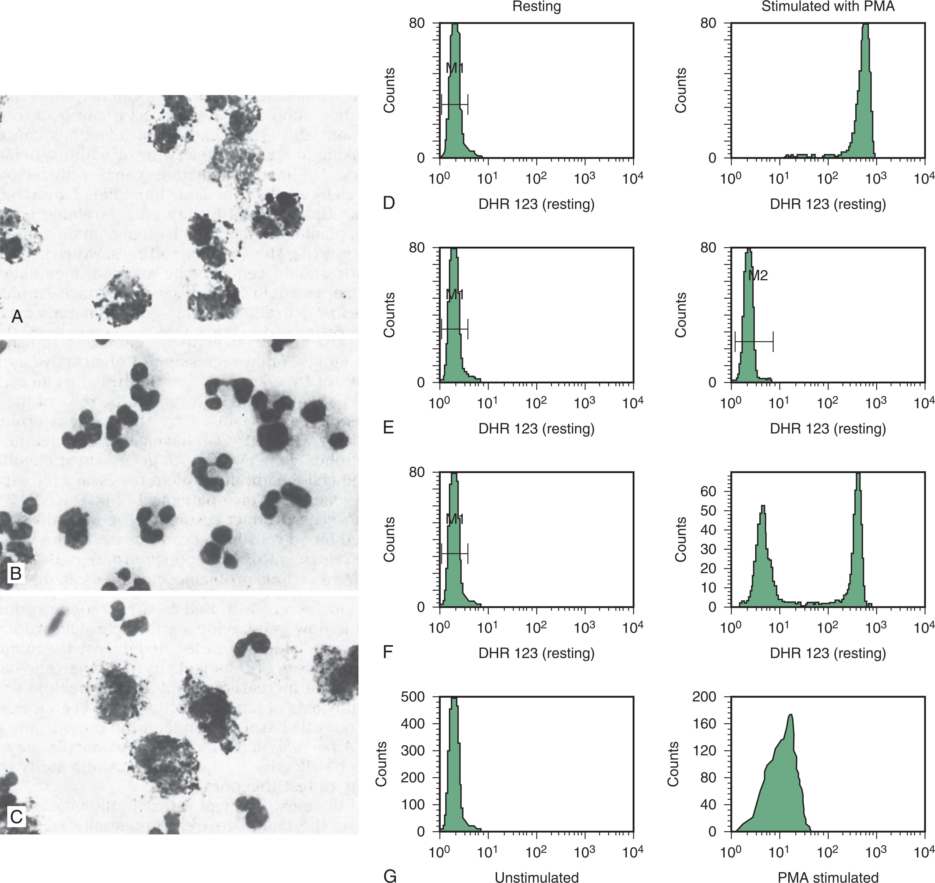 Figure 51.5, ANALYSIS OF NEUTROPHIL NICOTINAMIDE ADENINE DINUCLEOTIDE PHOSPHATE OXIDASE ACTIVITY FOR THE DIAGNOSIS OF CHRONIC GRANULOMATOUS DISEASE.