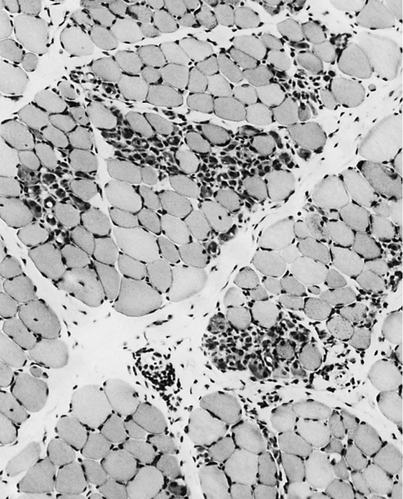 Fig. 109.12, Duchenne Muscular Dystrophy.