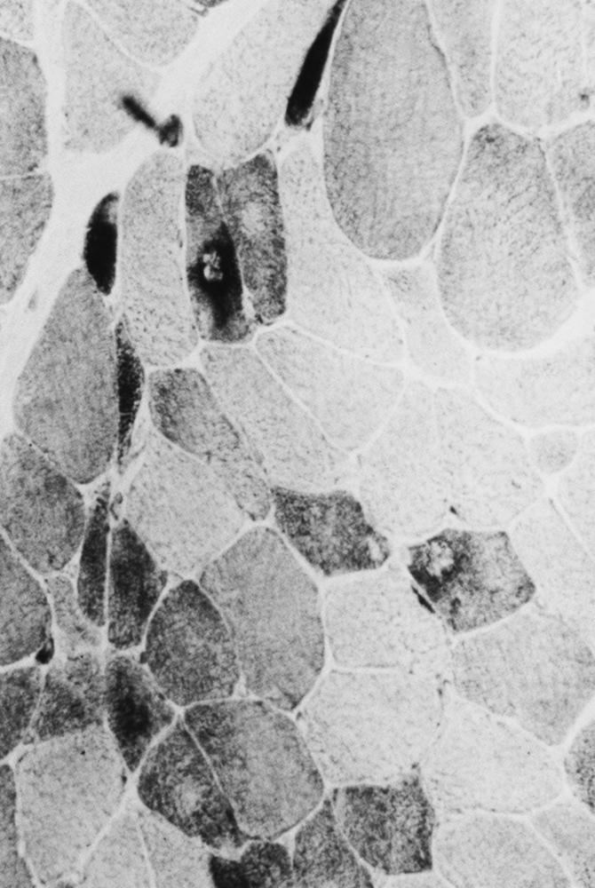 Fig. 109.4, Denervation.