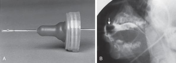 e-Figure 97.1, Modified feeding technique. (A) A number 8 silastic feeding tube is placed through a nipple so that a controlled introduction of contrast material can be made into the mouth, as the swallowing mechanism is observed. (B) Barium outlines the nipple (arrow) and the tube.