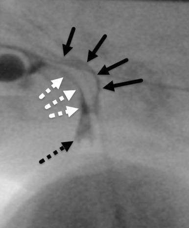 Figure 97.2, Pharyngonasal backflow. Lateral still image from a VFSS shows contrast from pharyngonasal backflow outlining the nasopharynx due to velopalatine insufficiency (black arrows) ; contrast along the posterior tongue (white dashed arrows) and in the vallecula (black dashed arrow) is normal during swallowing.