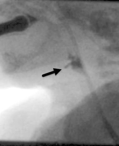 Figure 97.4, Shallow laryngeal penetration. Lateral still image from a VFSS shows contrast penetrating into the upper aspect of the laryngeal vestibule (arrow) but no contrast on the vocal cords or in the trachea.