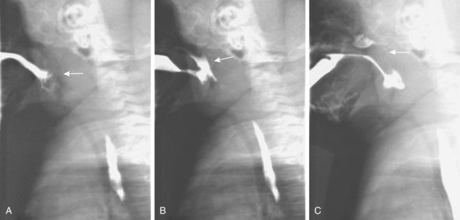 e-Figure 97.3, Pharyngonasal backflow.