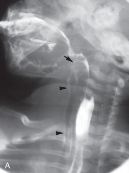 Figure 97.5, Aspiration. (A) Oblique image shows laryngeal penetration (arrow) and aspiration of contrast into the trachea (arrowheads) , secondary to lack of coordination during swallowing. (B) Oblique view reveals the extensive airway aspiration outlining bronchi and airspaces.