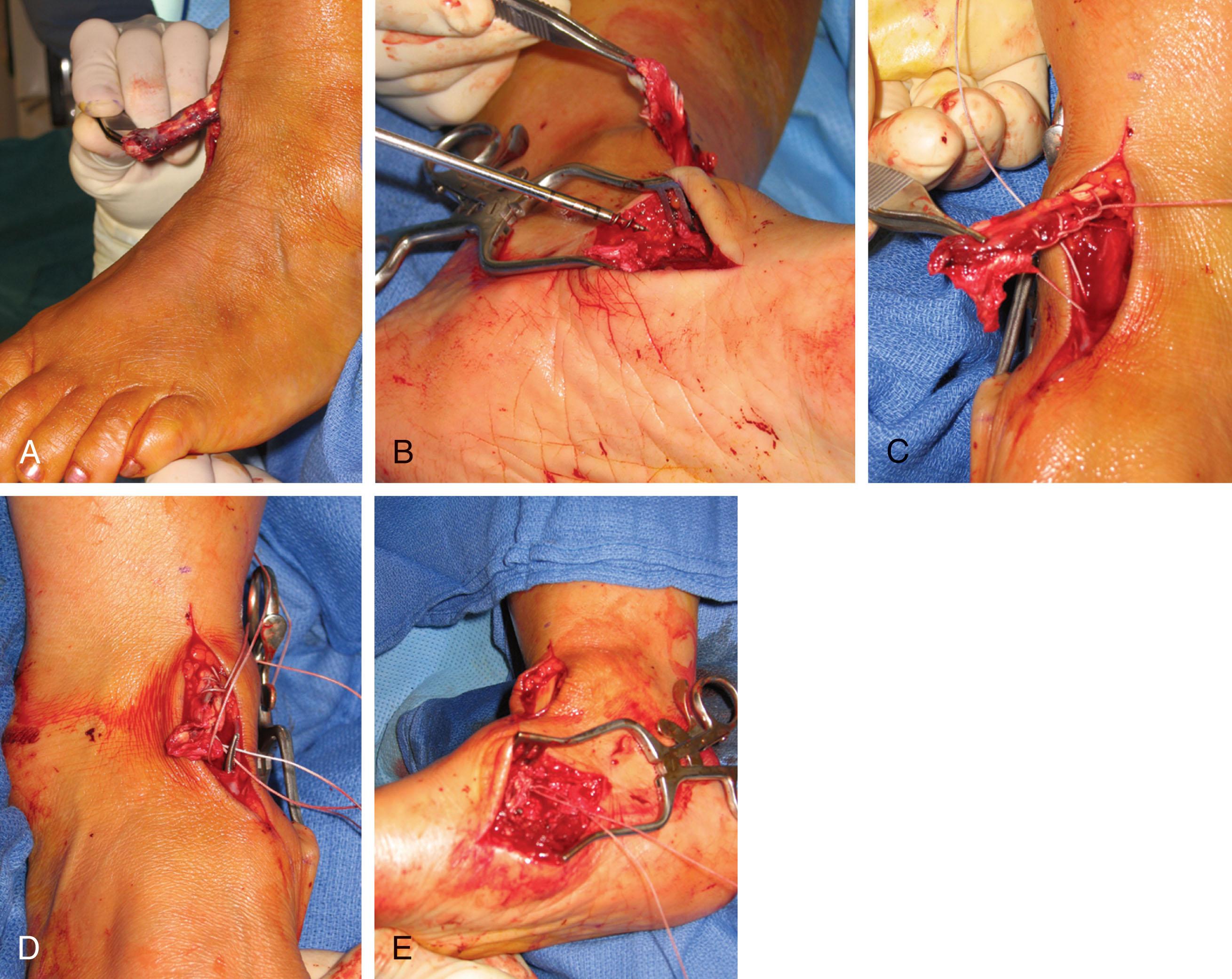 Fig. 28-11, A , Patient with acute rupture of the anterior tibial tendon. B , Krackow suture placed in the distal tendon stump. C , A suture anchor is placed at the old insertion site, which is prepared by lifting off local periosteum. D , Distal tendon is passed through a tunnel into its position at the plantar medial aspect of the medial cuneiform. E , After repair of the anterior tibial tendon to suture anchor.