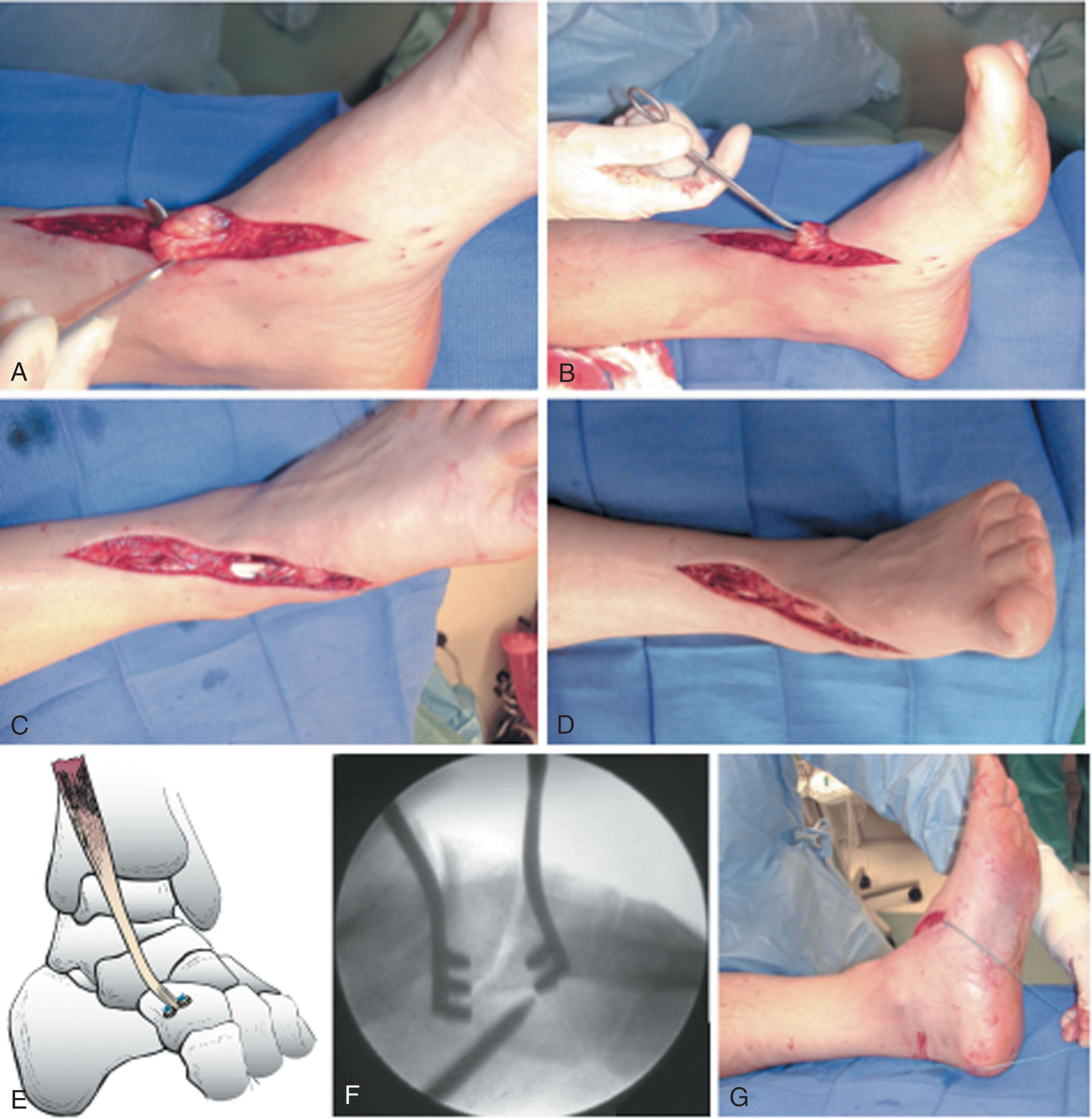 Fig. 28-12, A , Intraoperative photograph demonstrates a hematoma at the site of a recent anterior tibial tendon rupture. B , Ruptured anterior tibial tendon is pulled into the wound. C and D , Intraoperative photograph demonstrates primary repair of the tendon, with adequate dorsiflexion of ankle after repair. E , Placement of suture anchor into the navicular and placement into the cuneiform (F). G , Lateral view of ankle brought into dorsiflexion with securing of the tendon to the suture anchor.