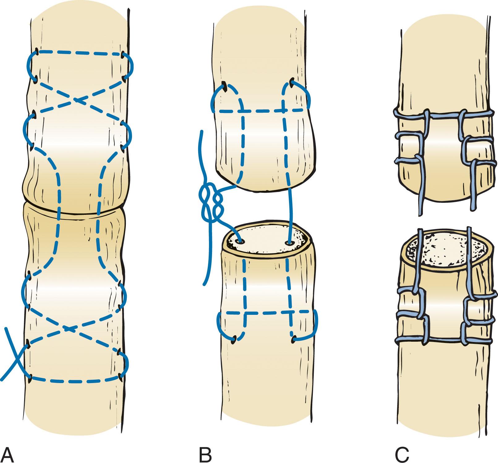 Fig. 28-13, Technique of tendon repair. A , Modified Bunnell technique. B , Kessler technique. C , Krackow technique.