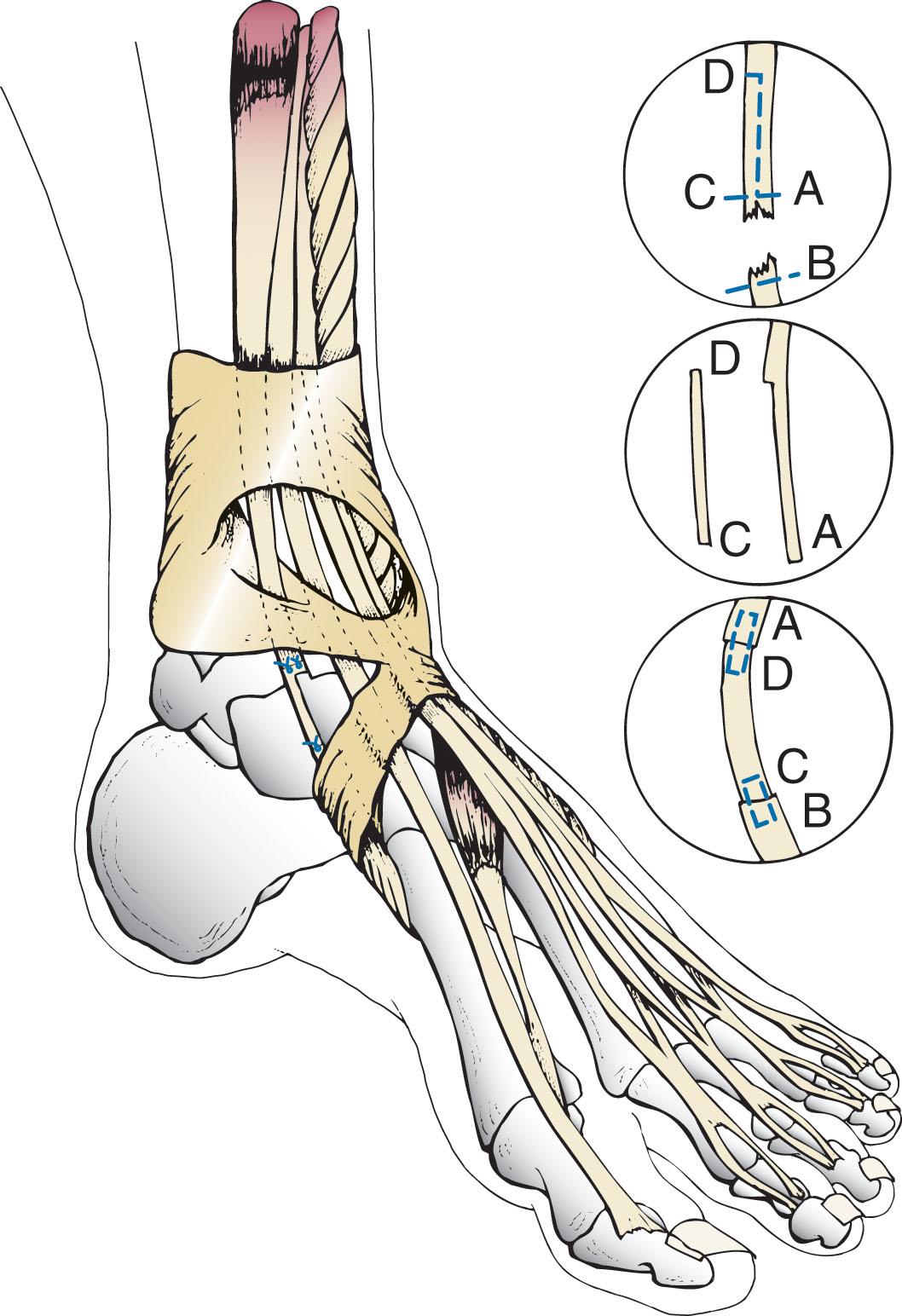 Fig. 28-14, Technique of sliding tendon graft as a delayed repair to bridge a defect in the tendon. ( A , Distal portion of proximal segment. B , Transverse cut on proximal aspect of distal segment. C and D , Ends of free segment to be transferred.)