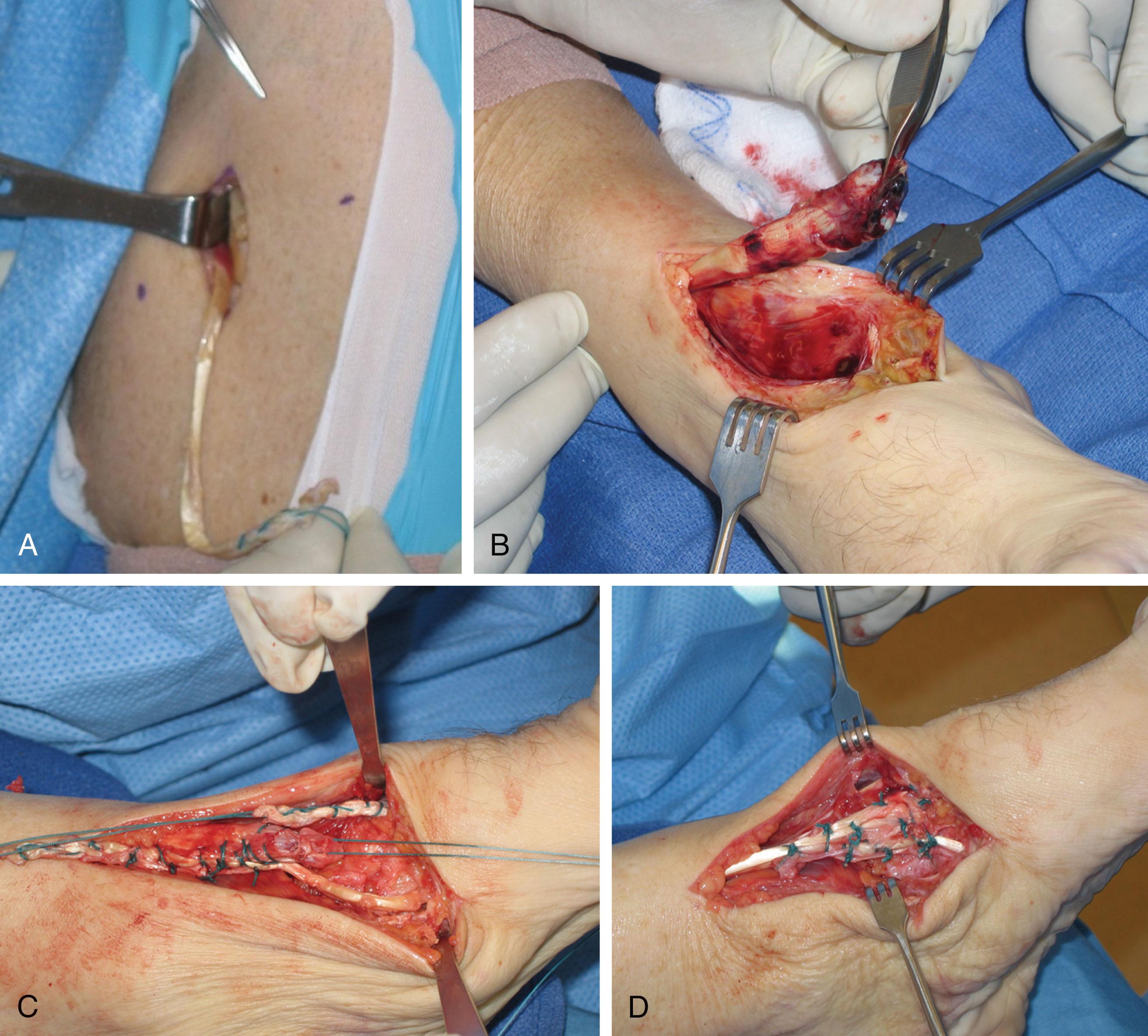 Fig. 28-15, Reconstruction of anterior tibial tendon rupture with gracilis tendon autograft. A , Harvest of gracilis autograft from ipsilateral knee. B , Ruptured anterior tibial tendon stump. C , The gracilis tendon autograft is passed through a drill hole in the medial cuneiform from plantar to dorsal. D , Completed anterior tibial tendon reconstruction with gracilis tendon autograft sutured in place.