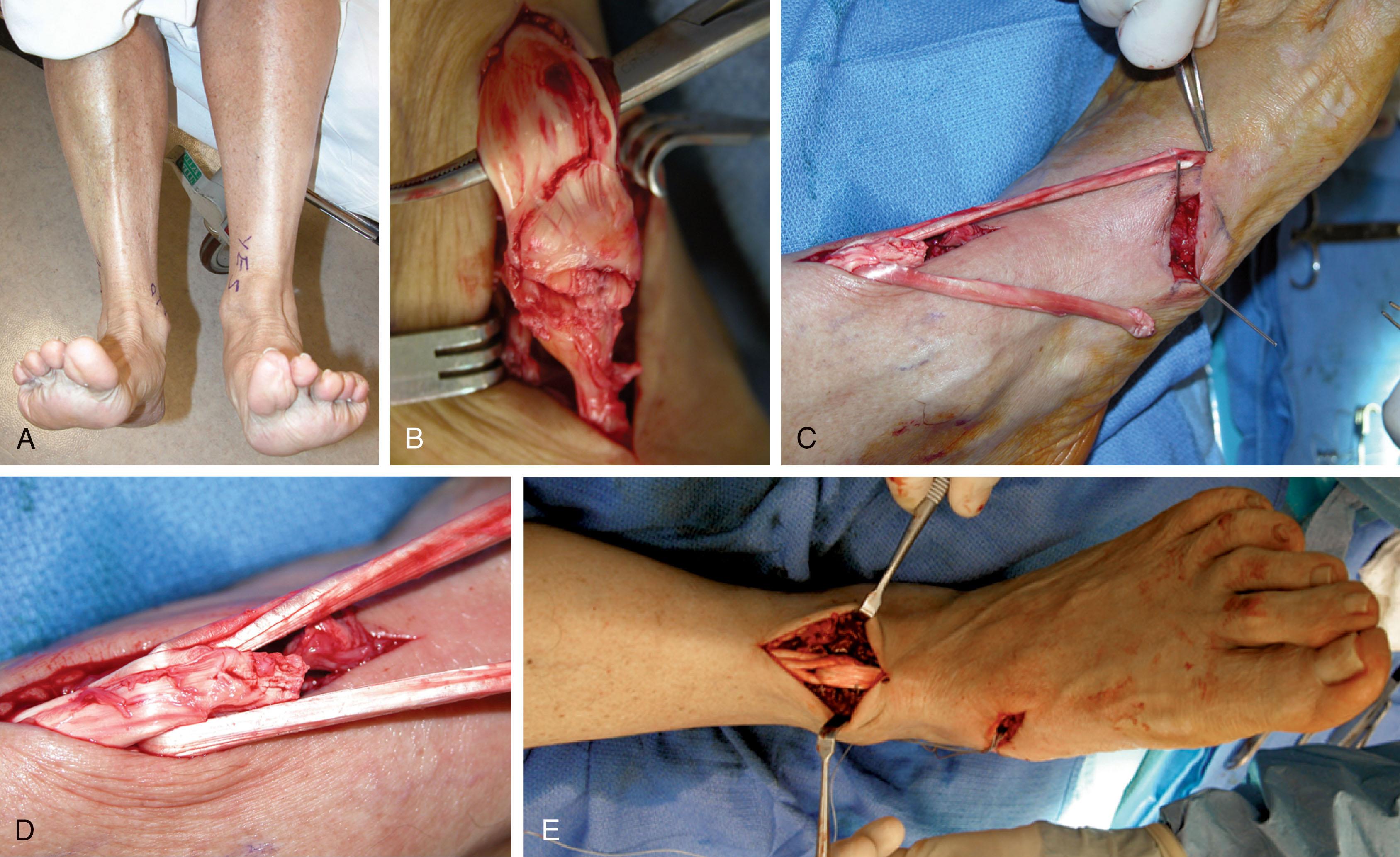 Fig. 28-16, A , Delayed diagnosis of rupture of anterior tibial tendon (left ankle). Note that the injured ankle dorsiflexes less and everts more. The medial ray is still relatively plantar flexed. B , Intraoperative photograph of rupture. C , Free tendon graft is passed through the distal end of the healthier aspect of the tendon, creating two graft ends for attachment. One limb is passed into a tunnel in the dorsal aspect of the cuneiform, and the other is passed into a more plantar medial tunnel as indicated by the protruding wires. The graft is secured using 6- to 7-mm–wide soft tissue interference screws. D , Close-up of graft through the anterior tibial tendon. E , After completion of repair. Tensioning the graft is critical to achieve dorsiflexion.