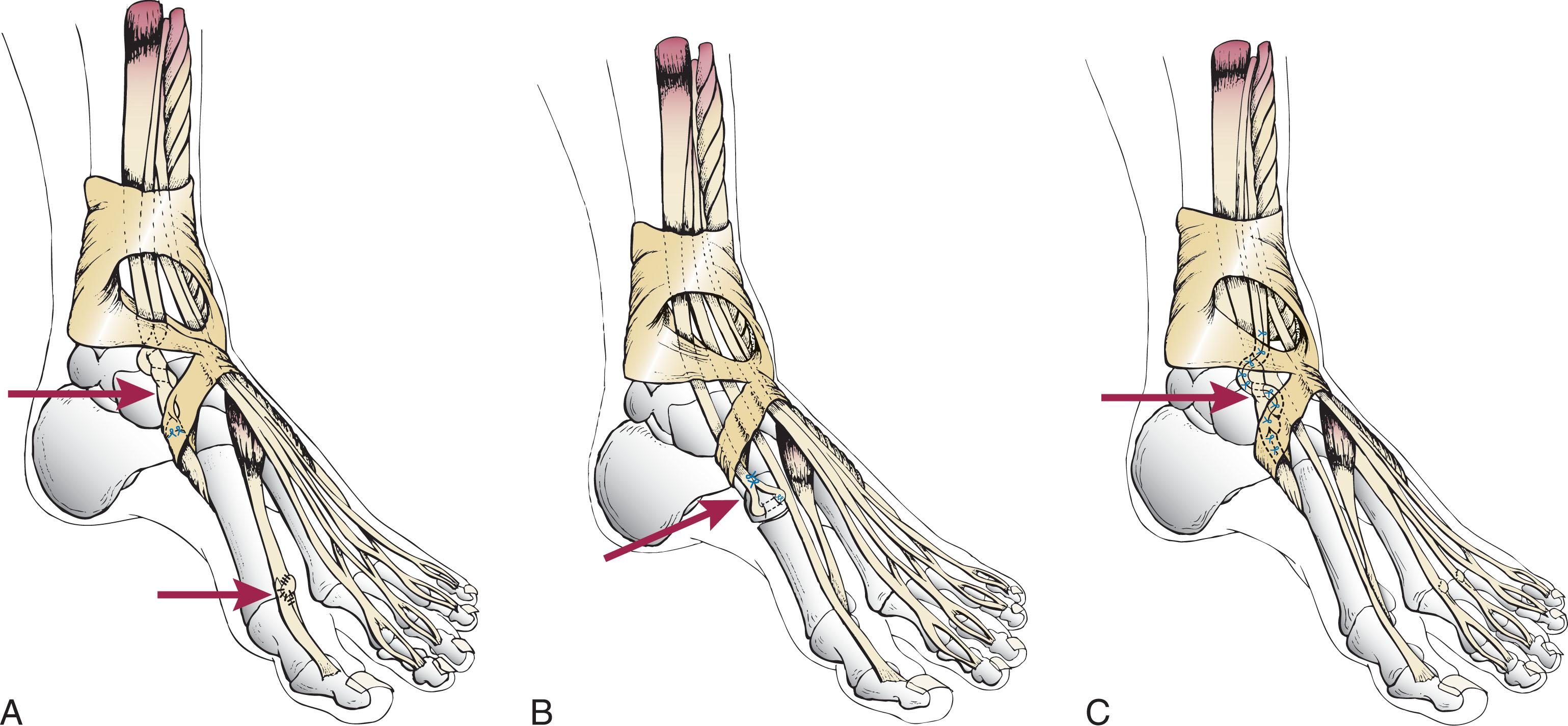 Fig. 28-17, A , Reconstruction of anterior tibial tendon using Pulvertaft weave of extensor hallucis longus tendon into distal anterior tibial tendon. B , Reconstruction of distal rupture of anterior tibial tendon. Tendon is advanced through a horizontal drill hole in the navicular or first cuneiform and sutured to itself. C , Reconstruction of ruptured anterior tibial tendon using Kelikian procedure. Extensor digitorum longus (EDL) tendon to second and third toes is woven through anterior tibial tendon. EDL tendon to second and third toes is tenodesed to the extensor digitorum brevis.
