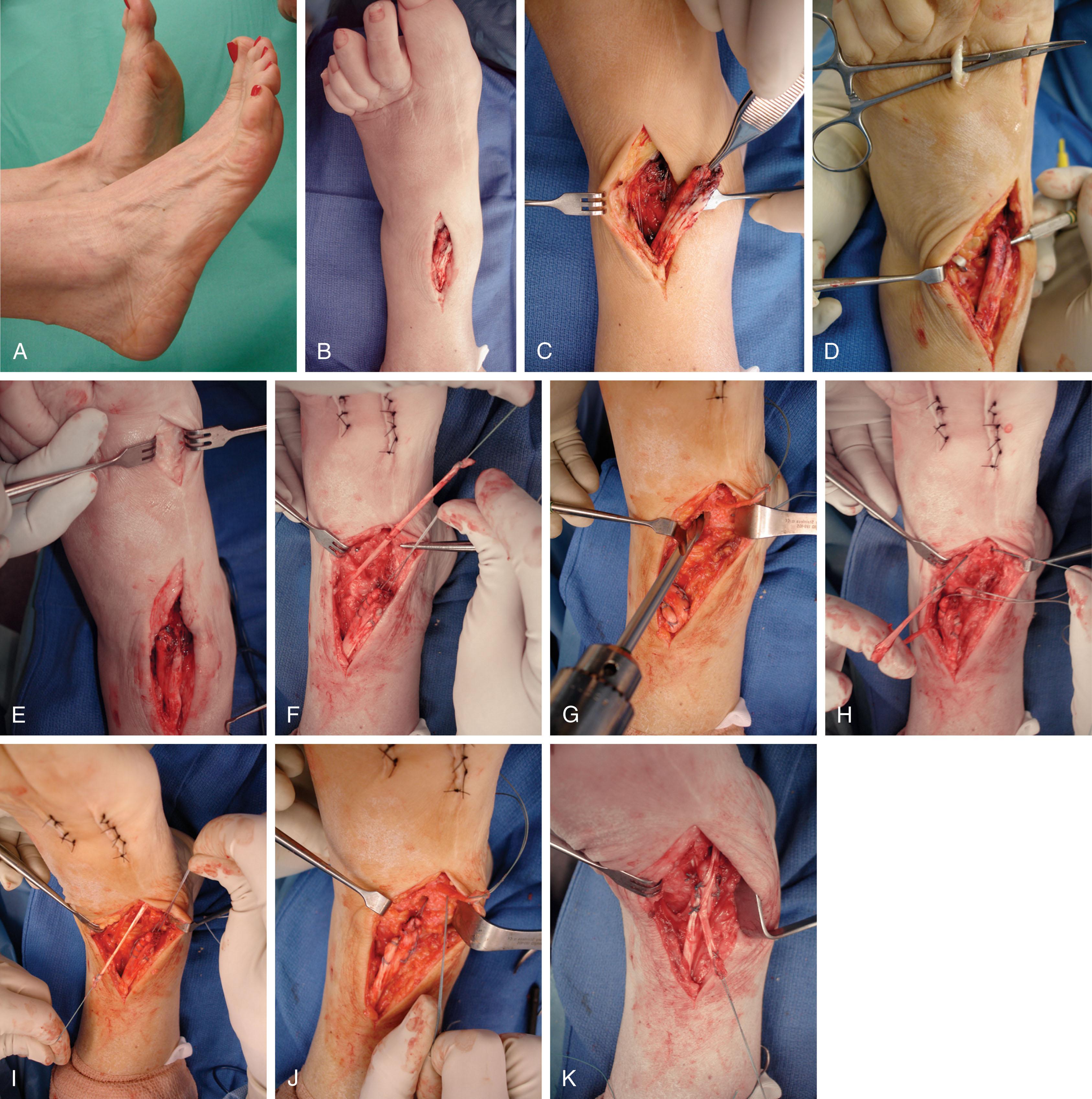 Fig. 28-19, Rupture of anterior tibial tendon reconstructed with extensor digitorum longus (EDL) transfer. A , Clinical examination demonstrates lack of dorsiflexion of right ankle. B , Initial exposure demonstrating rupture of anterior tibial tendon. C , After debridement of tendon stump. D , Distal exposure of extensor to the second toe and exposure of extensor hallucis longus. E , After tenodesis of distal extensor tendon of the second toe to the extensor hallucis longus. F , After release of the EDL to second toe, the proximal tendon is pulled into the dorsal wound (there is plenty of EDL tendon length for the reconstruction). G , A transverse drill hole is placed in the medial cuneiform. H , The EDL tendon is pulled into the drill hole. (Note Krakow suture in the distal anterior tibial tendon stump.) I and J , The stump of the anterior tibial tendon is sutured to the EDL tendon, which is pulled through the drill hole in the cuneiform and tensioned. K , Final sutures in the reconstruction.