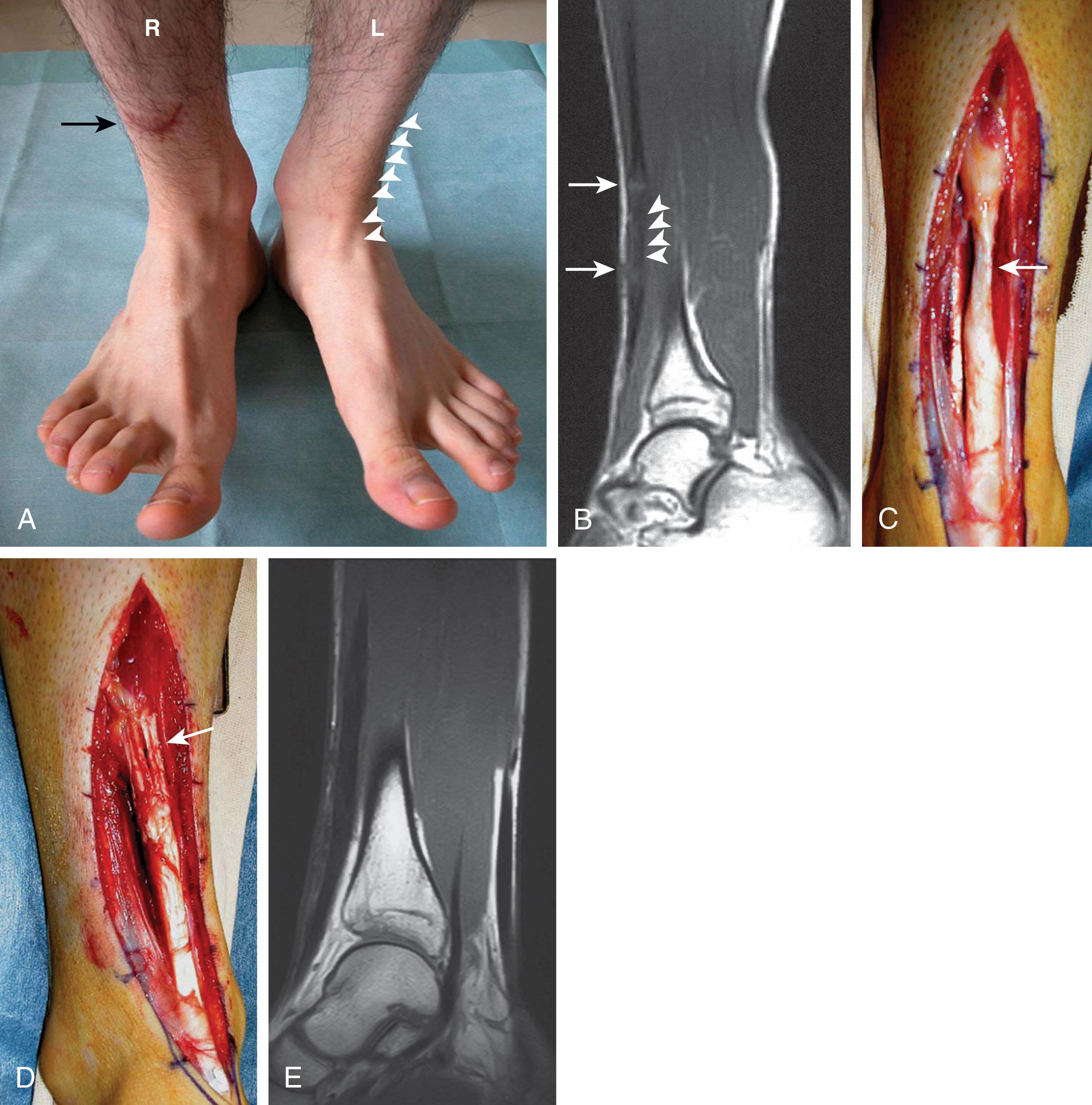Fig. 28-20, Reconstruction of anterior tibial tendon with quadruple gracilis tendon graft. A , Six weeks after injury, note scar on right shin, with loss of anterior tibial tendon contour. The white arrowheads denote the normal contour of the tendon; the large black arrow denotes the transverse scar. B , Preoperative T1- weighed sagittal magnetic resonance image (MRI) of the right leg shows a gap between stumps of the tendon ( white arrows and arrowheads ). C , Thin cord of fibrous scar tissue ( white arrow ) connects the two tendon stumps of the anterior tibial tendon. D , After quadrupled gracilis graft bridges the tendon gap. White arrow denotes area of tendon repair. E , Postoperative MRI at 1 year shows the reconstructed anterior tibial tendon.