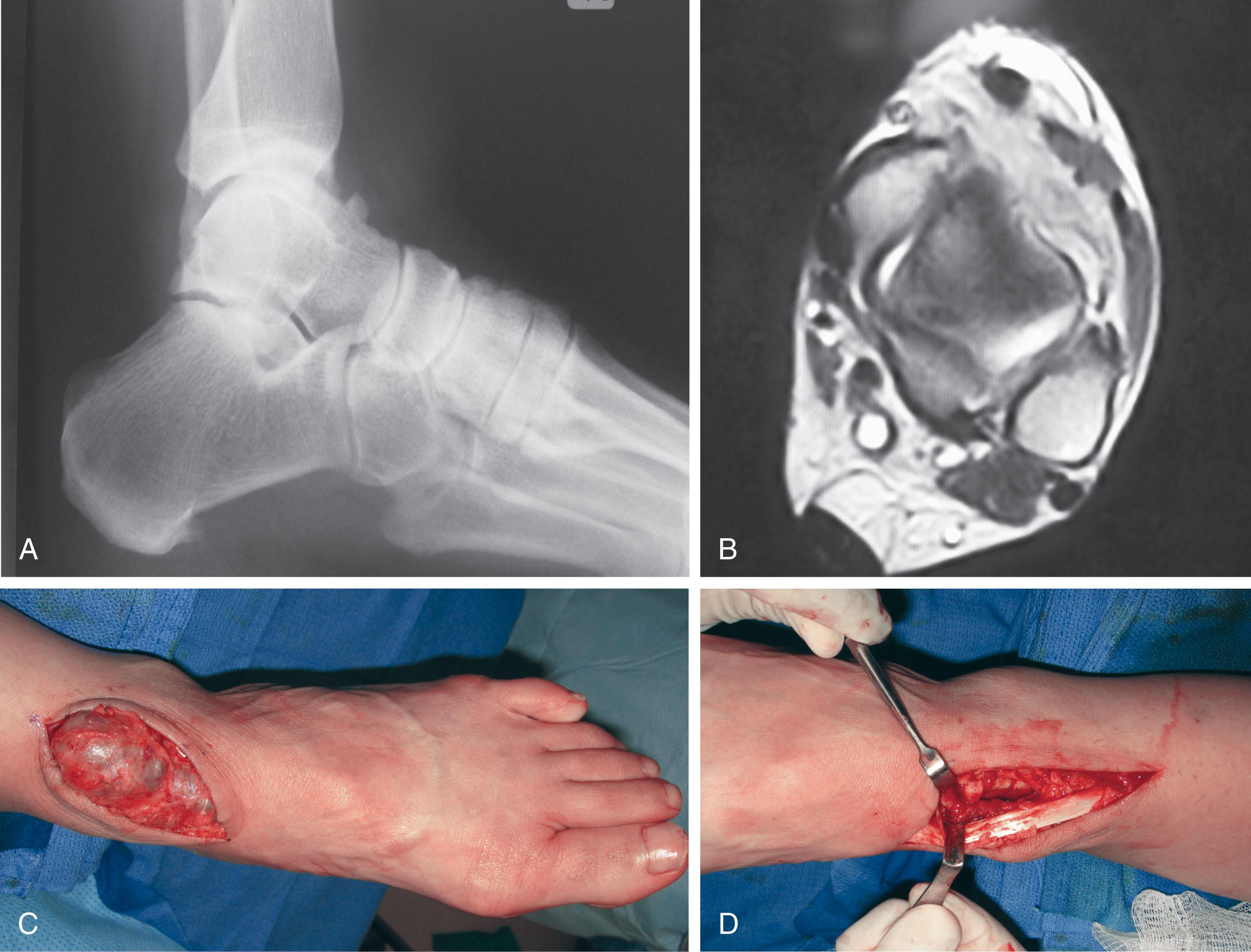 Fig. 28-2, Ganglion of the anterior ankle region eroding the anterior tibial tendon, masquerading as a tendon rupture. A , Lateral radiograph with dorsal talar spur. B , Magnetic resonance image demonstrating a mass anterior to the anterior tibial tendon. C , Mass at surgery. D , After resection, the anterior tibial tendon is intact. The joint is exposed to remove the osteophytes.