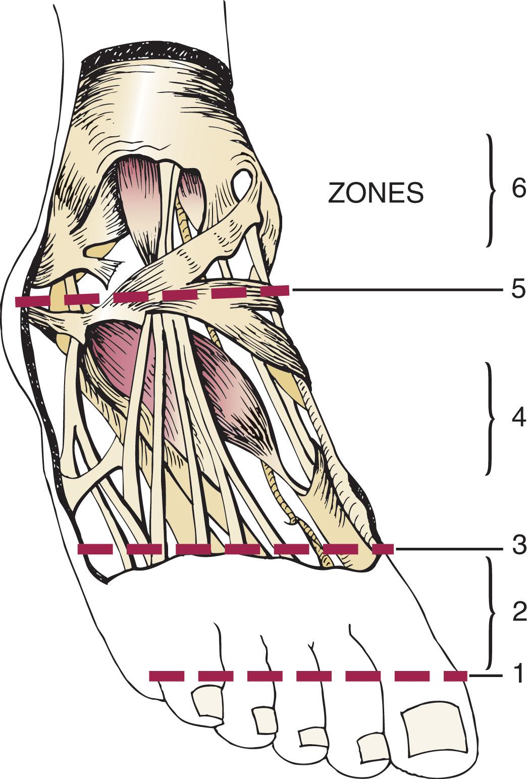 Fig. 28-21, At the level of the ankle joint, the extensor hallucis longus becomes tendinous as it courses between superior and inferior extensor retinaculum. The six zones of laceration of the extensor hallucis longus are illustrated.