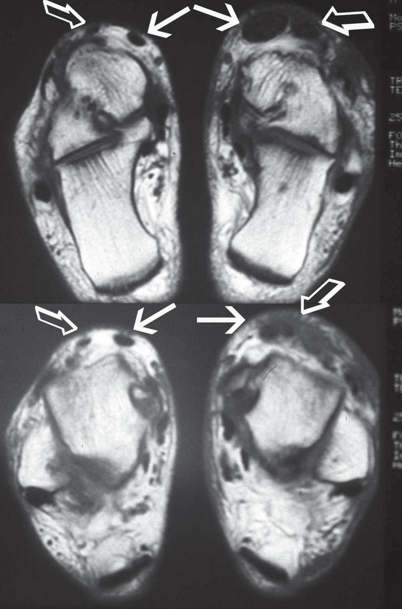 Fig. 28-22, Magnetic resonance images demonstrating normal tendons on the left and injured extensor hallucis longus and anterior tibial tendon on the right after an anterior ankle deep laceration. The solid arrows indicate the anterior tibial tendon, and the open arrows indicate the extensor hallucis longus.