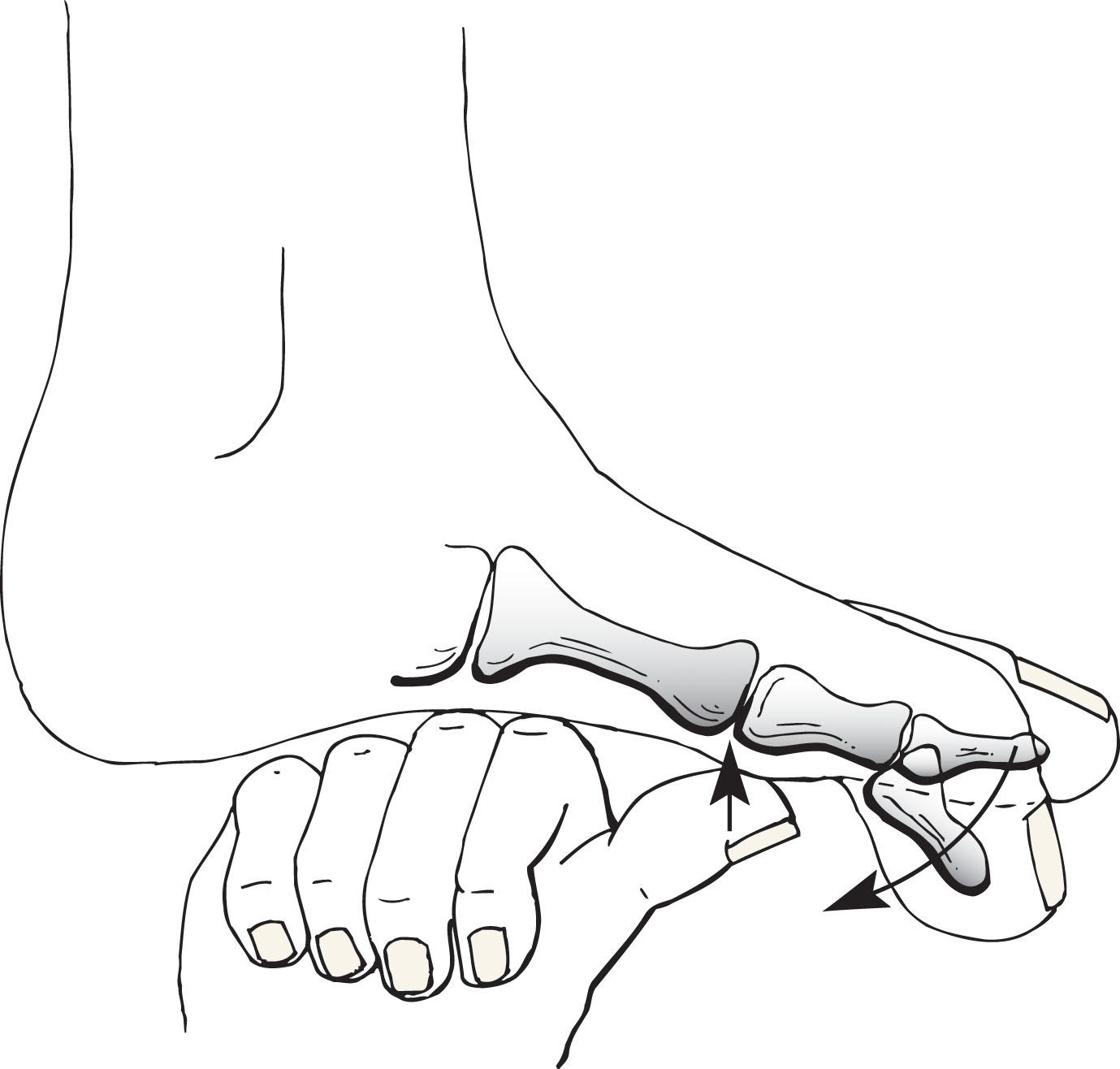 Fig. 28-23, Technique of push-up test to examine function of the extensor hallucis longus (EHL). A thumb or finger is pressed on the plantar aspect of the first metatarsophalangeal joint. With unopposed function of the flexor hallucis longus, the interphalangeal joint flexes, demonstrating discontinuity or dysfunction of the EHL.