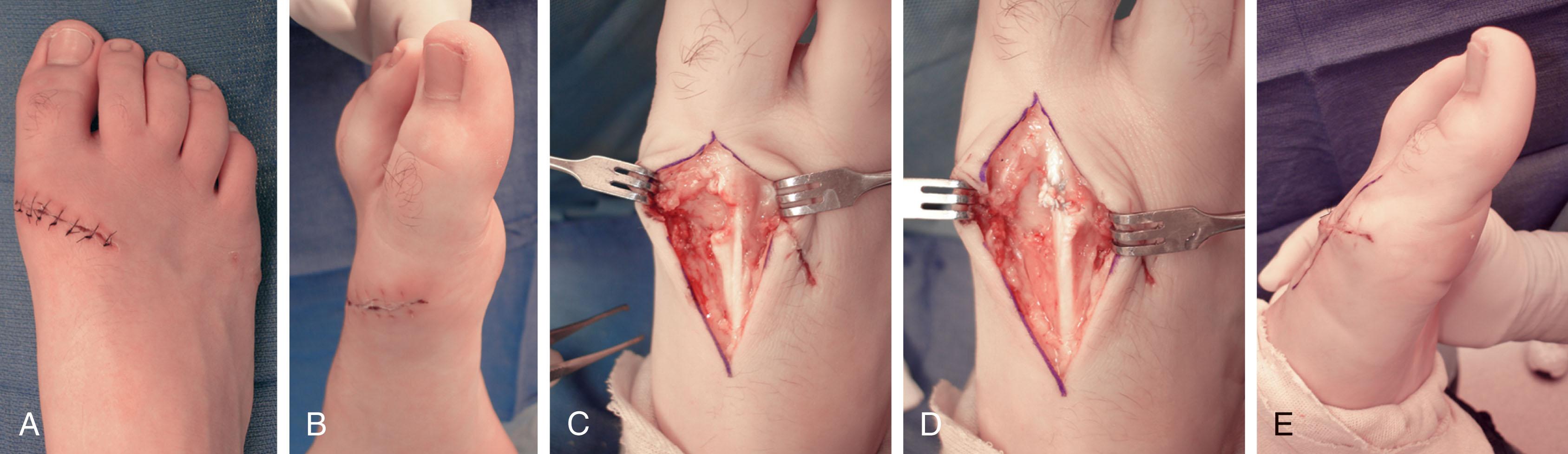 Fig. 28-24, Distal laceration of extensor hallucis longus (EHL; zone 3). A , Laceration closed in emergency room without repair of tendon. B , Note extensor lag of the hallux. C , Exploration defining intact extensor hallucis brevis and complete laceration of extensor hallucis longus. D , After primary repair of EHL. E , Note extension of the hallux after the repair.