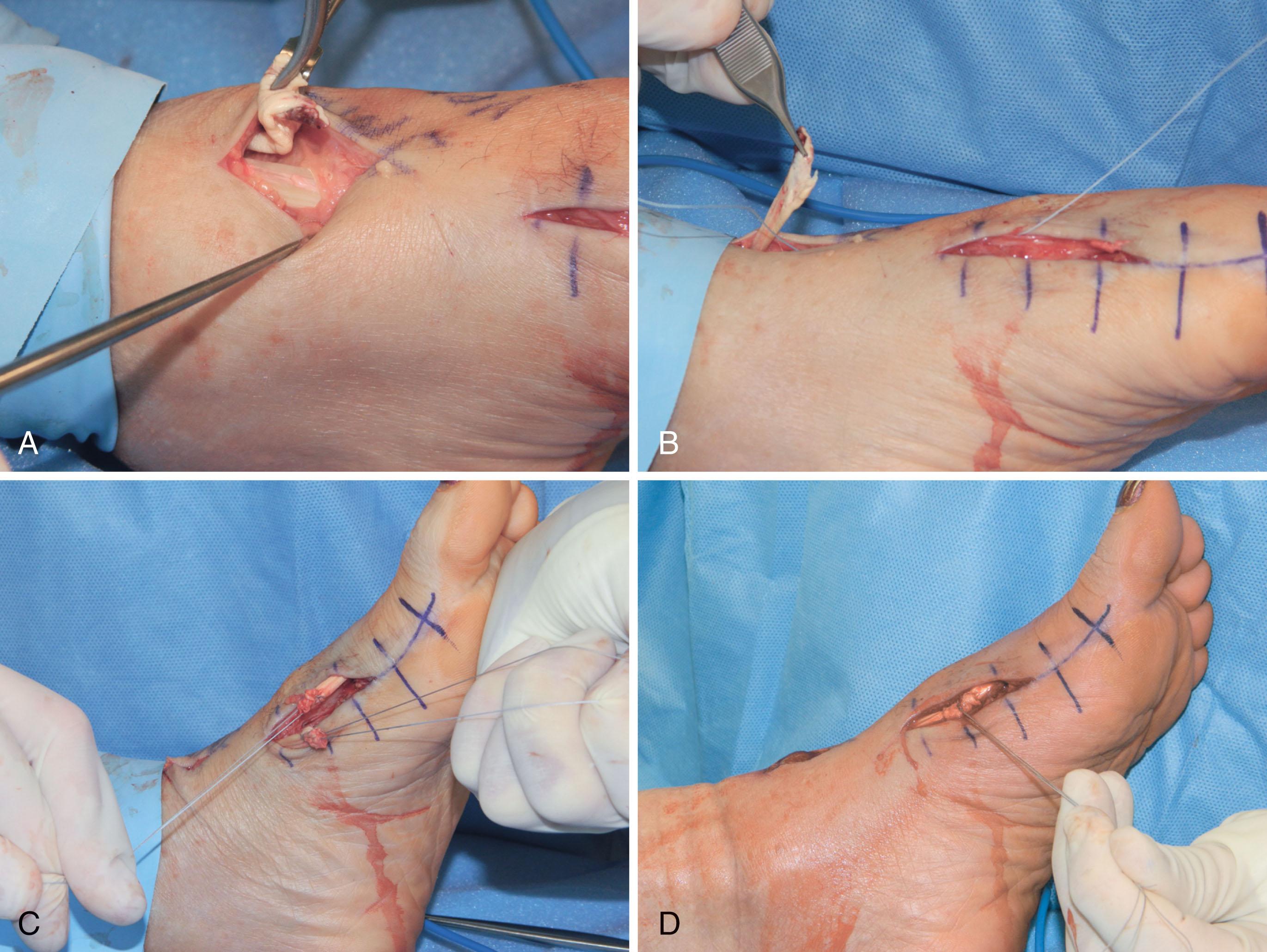 Fig. 28-25, Laceration of extensor hallucis longus (zone 4). A , Distal laceration of extensor hallucis longus (tendon found at edge of extensor retinaculum). B , Preparation for transfer of tendon distally. C , Krakow suture placed at end of both tendons ends. D , After repair of tendon laceration.