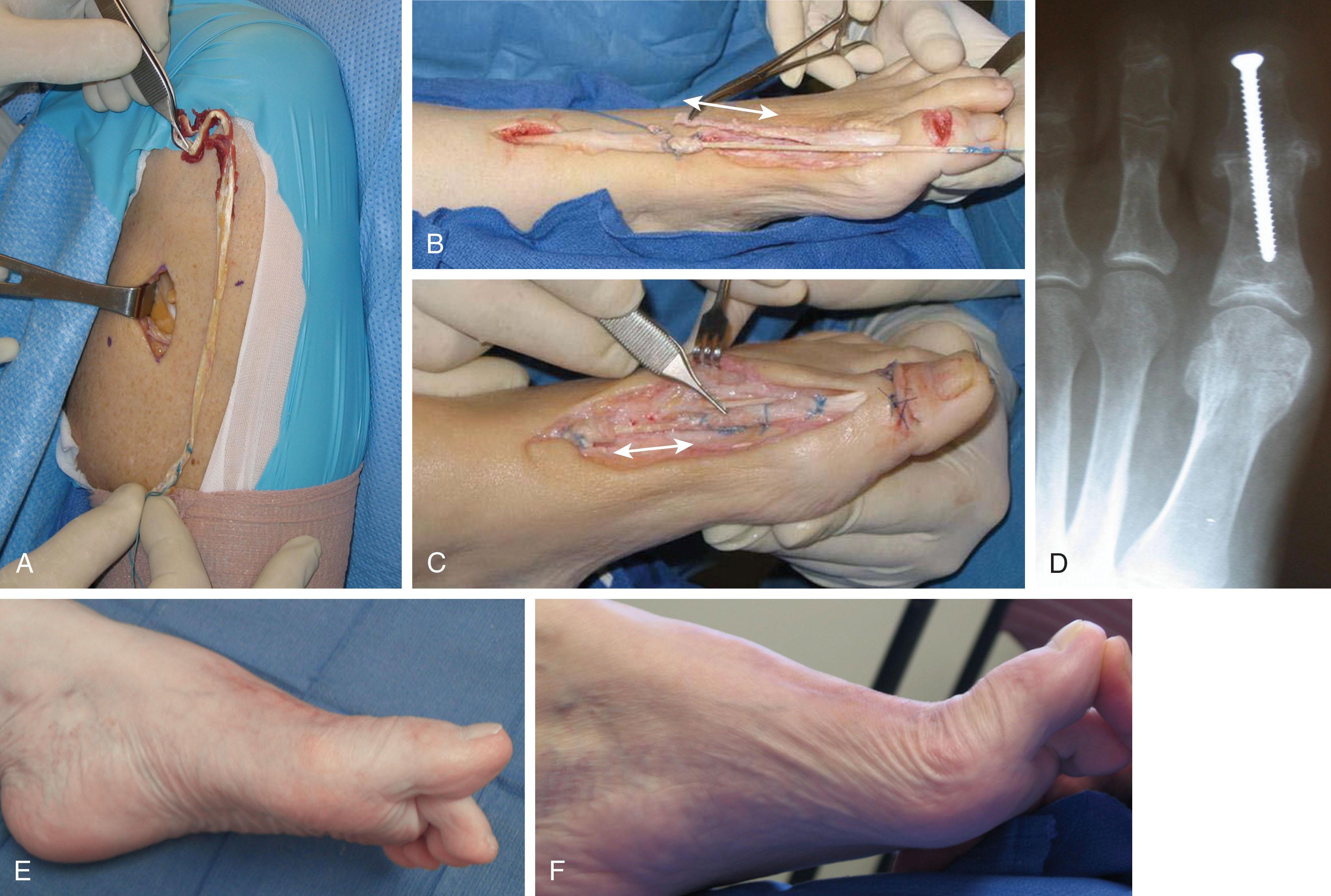 Fig. 28-26, Delayed reconstruction of extensor hallucis longus (EHL) tendon with gracilis tendon allograft. A , The gracilis tendon is harvested from the ipsilateral knee. B , Tenolysis of the EHL is performed, and then a gracilis autograft is sutured to the proximal EHL stump with a Pulvertaft weave technique. Arrow illustrates the proliferative scar tissue attached to the distal stump of tendon that, when resected, leaves a 3-cm gap. C , The tendon graft has been sutured to the distal stump but also secured through a transverse drill hole in the proximal phalanx. An interphalangeal joint arthrodesis has been performed. The arrow denotes that the 3-cm defect has been spanned with the gracilis tendon autograft. D , Anteroposterior standing radiograph demonstrates the interphalangeal joint arthrodesis. E , Active extension of the hallux metatarsophalangeal (MTP) joint is demonstrated 6 months after reconstruction. F , The hallux MTP joint demonstrates 60 degrees of passive motion postoperatively.