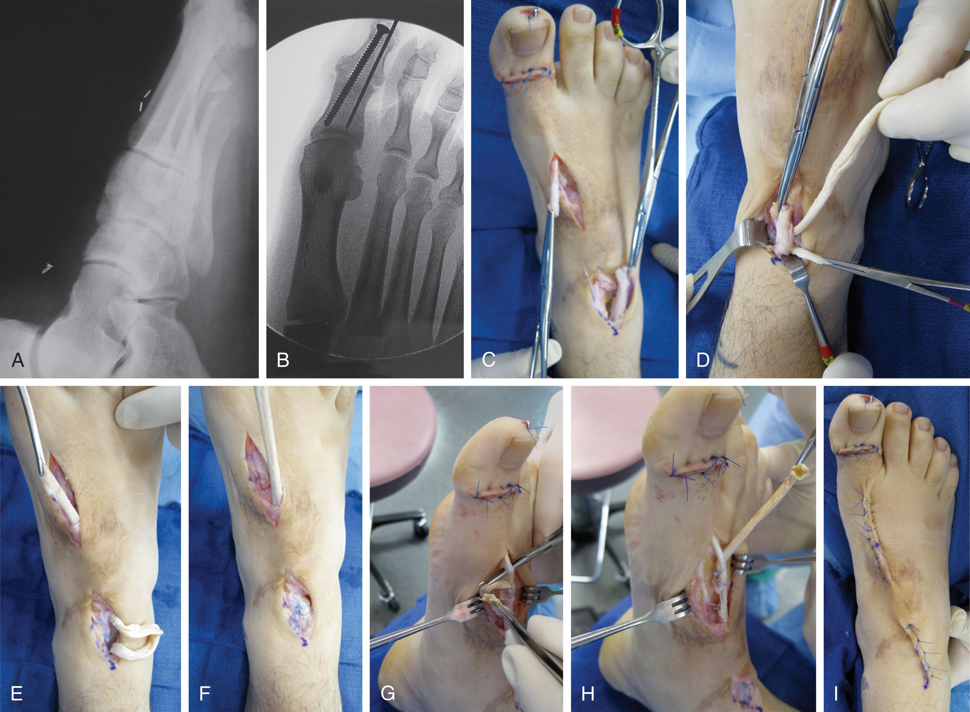 Fig. 28-27, Delayed repair of extensor hallucis longus laceration, 1 year after injury (zone 4 injury). A , Lateral radiograph shows clips at ends of distal stump and proximal stump with retraction beneath the extensor retinaculum. B , Interphalangeal joint fusion completed. C , Krakow-type suture placed in proximal end of distal stump. Distal end of proximal stump grasped with clamp (3–4 cm gap in tendon) . D , Allograft weaved through proximal stump. E and F , Allograft is pulled distally beneath skin bridge. G and H , Pulvertaft weave of tendon graft through the distal stump. I , Completed delayed extensor hallucis longus reconstruction.