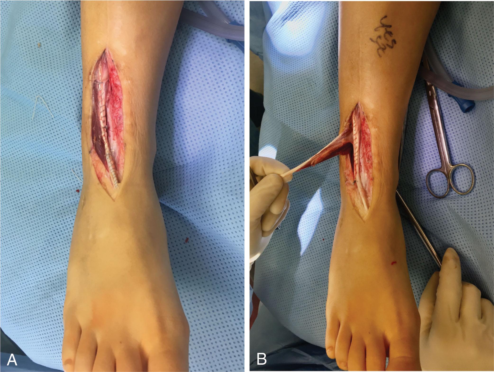 Fig. 28-28, The peroneus tertius can harvested for delayed EHL reconstruction. A , The patient has undergone side-to-side transfer of the EDL as well to bridge the gap. B , The peroneus tertius was harvested and used to supplement the EDL transfer.