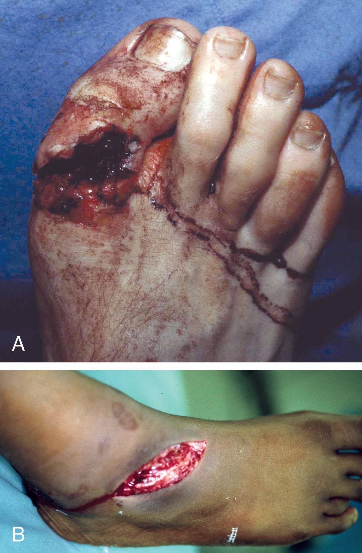 Fig. 28-29, A , Dorsal toe laceration with distal disruption of extensor hallucis longus. After resection of the margins of the wounds, the tendon was repaired. B , Dorsal lateral foot laceration with disruption of the extensor tendons and preservation of the extensor hallucis longus tendon. After wound debridement, longitudinal proximal and distal extensions of the wounds permitted repair of the tendons.