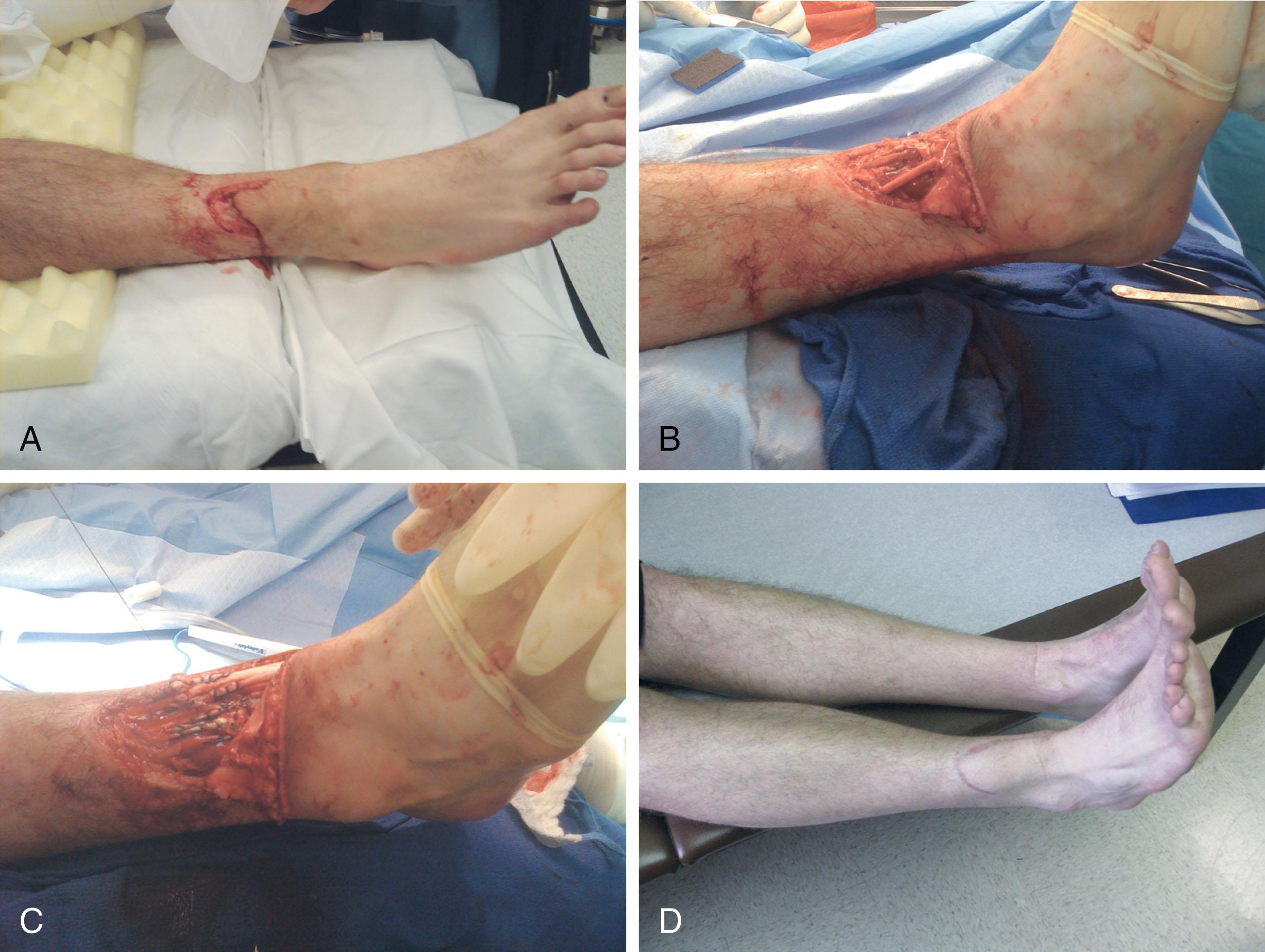 Fig. 28-30, Extensor digitorum longus laceration. A , Oblique laceration of the lower leg. B , Laceration has led to transection of both the extensor digitorum longus and the extensor hallucis longus, leaving an inability to extend any of the toes. Weakness of ankle dorsiflexion is commonly observed as well. C , After acute repair. D , Toe function after repair; note identical dorsiflexion of all the toes.