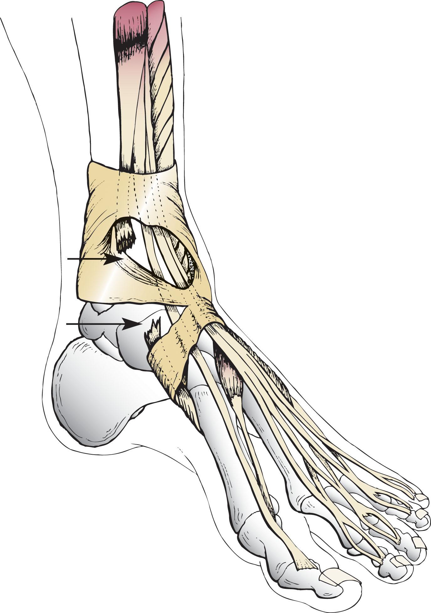 Fig. 28-3, Spontaneous rupture of anterior tibial tendon (arrows) typically occurs in distal 3 cm of tendon.
