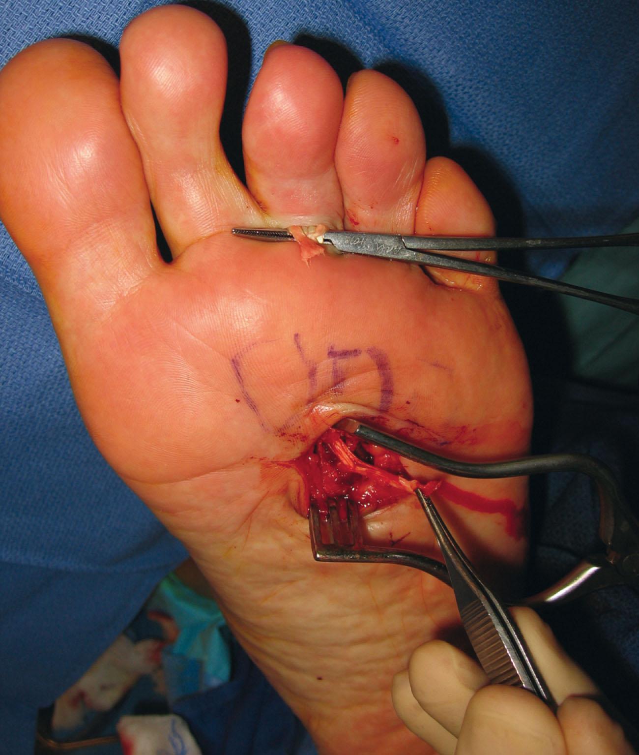 Fig. 28-32, Rupture of flexor digitorum longus. The patient had received multiple cortisone injections as treatment for interdigital neuromas. He ultimately developed a bothersome dorsiflexion posture of the toe and an unstable painful metatarsophalangeal joint and an inability to flex the toe. At surgery, the flexor tendon was identified distal and proximal to the weight-bearing plantar fat pad. The tendon ends proximally and distally are sutured with a free graft of extensor digitorum brevis, which was interposed. The tendon is passed through the sheath with a clamp and secured.