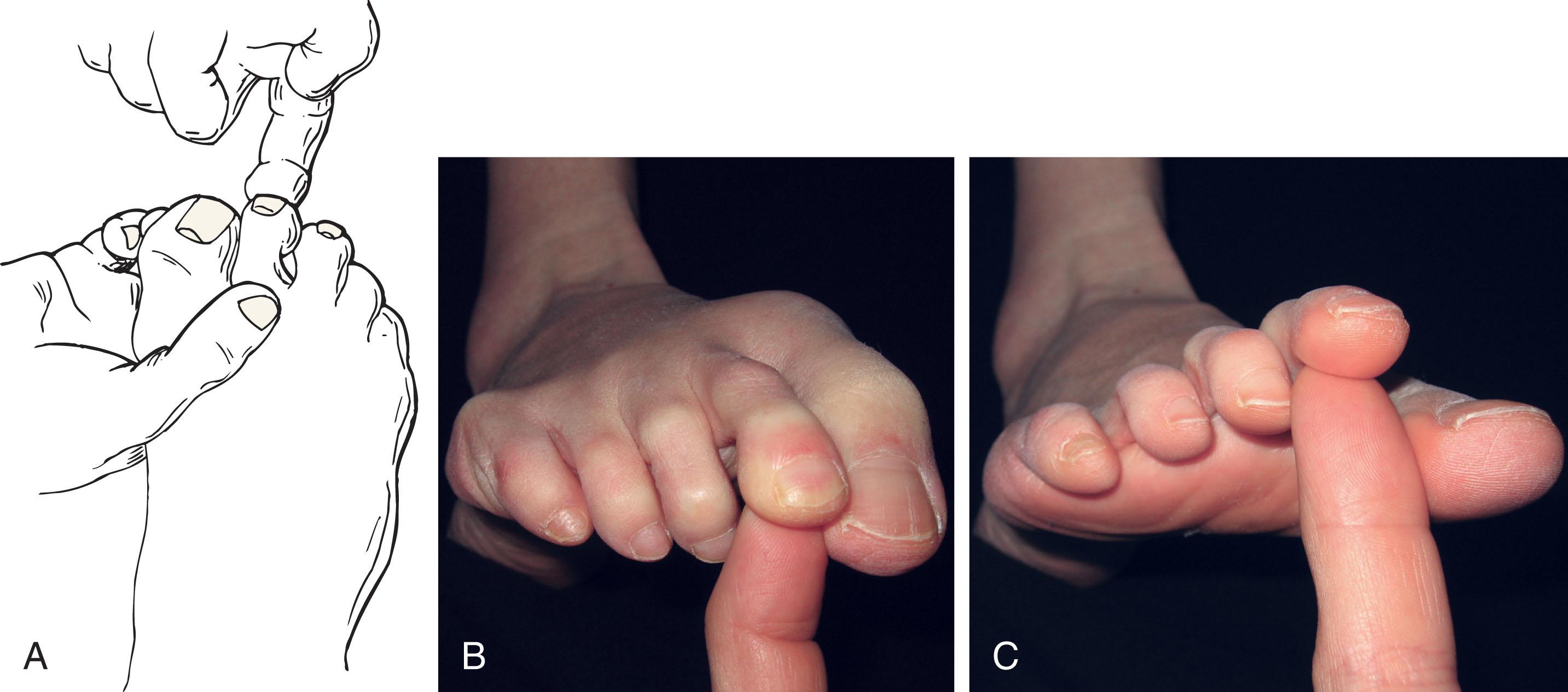 Fig. 28-33, A , Function of the flexor digitorum longus tendon can be assessed by grasping the forefoot, stabilizing the metatarsophalangeal joint, and requesting the patient to flex the tip of the toe against resistance. B , Clinical photograph of intact tendon. C , Absence of flexor strength after disruption of the flexor digitorum longus.