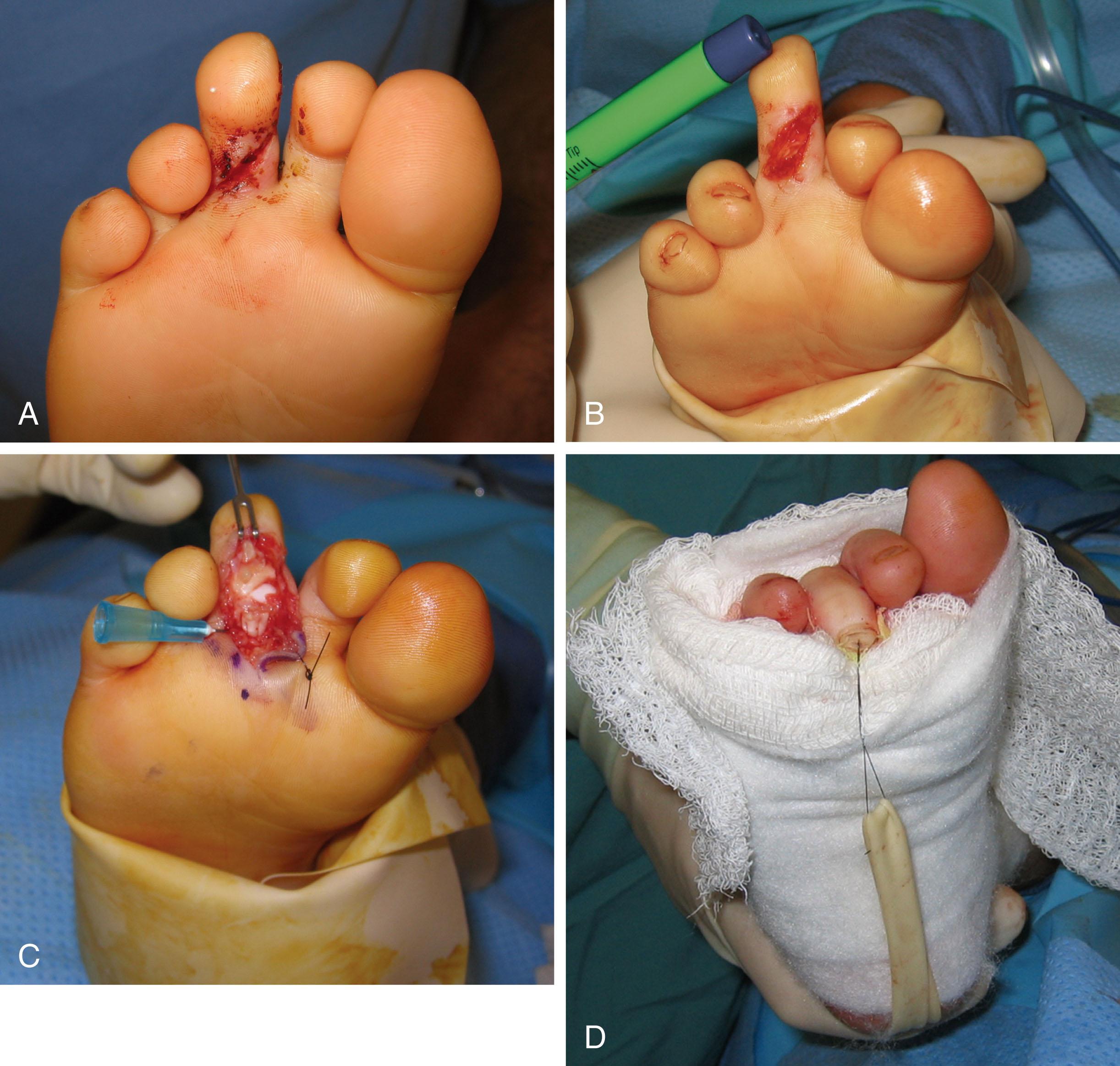 Fig. 28-34, A , An acute laceration on the underside of the toe penetrated the flexor digitorum longus (FDL), flexor digitorum brevis, and plantar proximal interphalangeal capsule. B , There is no resistance to extension of the digit. C , The laceration is extended, creating a Z-shaped incision. The flap of skin is sutured to the sole of the foot to permit retraction. A 25-gauge needle is passed through the proximal tendon once the FDL tendon is delivered into the wound to keep it in position during suturing. One limb of the FDL is repaired—not both—to avoid bulk and difficulty reestablishing tendon gliding. The flexor digitorum brevis and capsule are also repaired. The sutures were placed in all the structures, and then the knots were tied with the toe in the flexed position. D , 3-0 Nylon is placed through the tip of the nail and then looped around a Penrose drain, which is anchored into the dressing to maintain flexion.