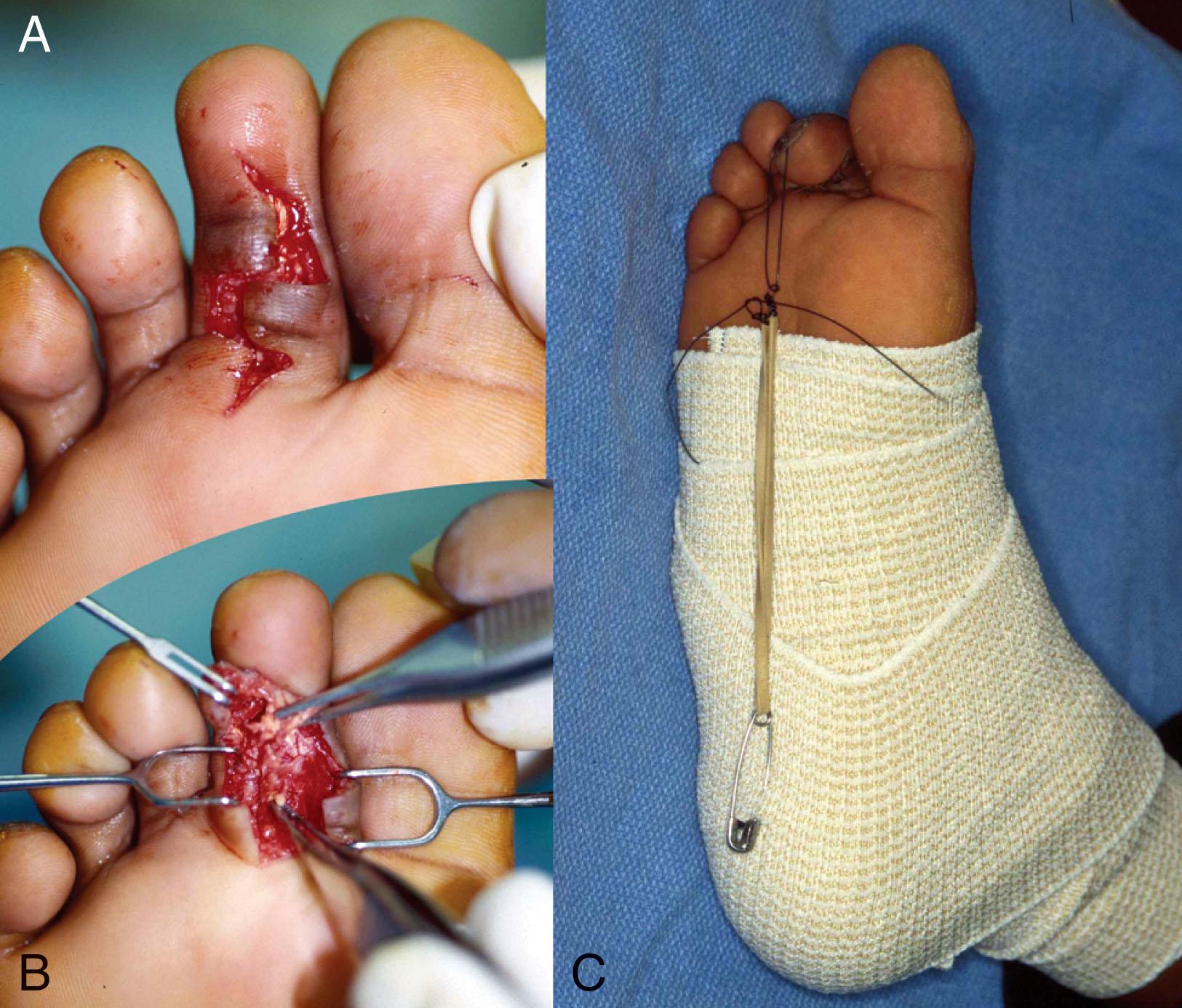 Fig. 28-35, Laceration of the flexor digitorum longus in the phalangeal region. A , Acute injury. B , After repair. C , Use of dynamic splint to protect repair.