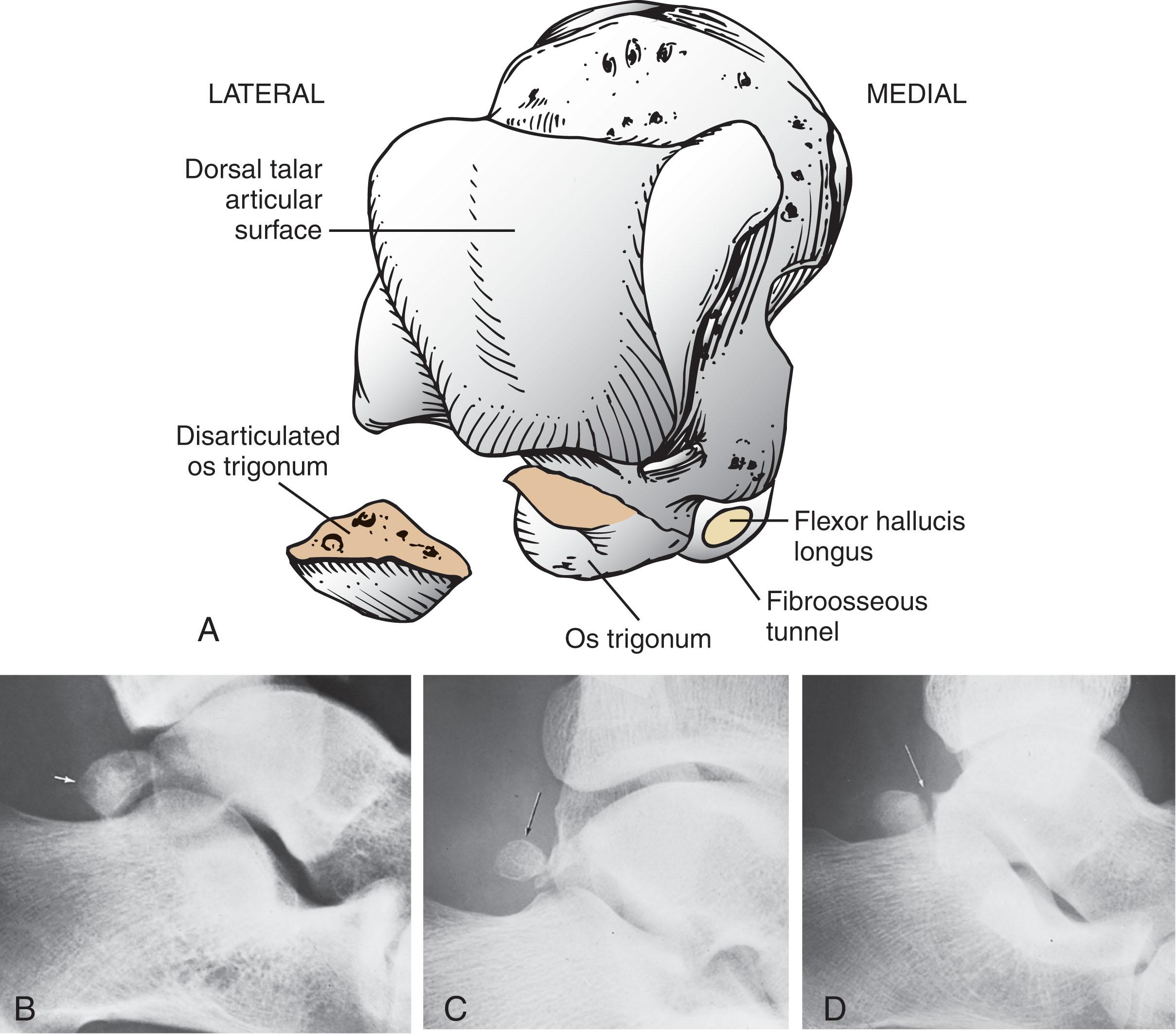 Fig. 28-36, A , Flexor hallucis longus tenosynovitis may be exacerbated by an adjacent os trigonum. B to D , Varying sizes and shapes of the os trigonum. ( B – D , From Keats TE: Atlas of normal roentgen variants that simulate disease, ed 4. St. Louis, Mosby, 1987.)