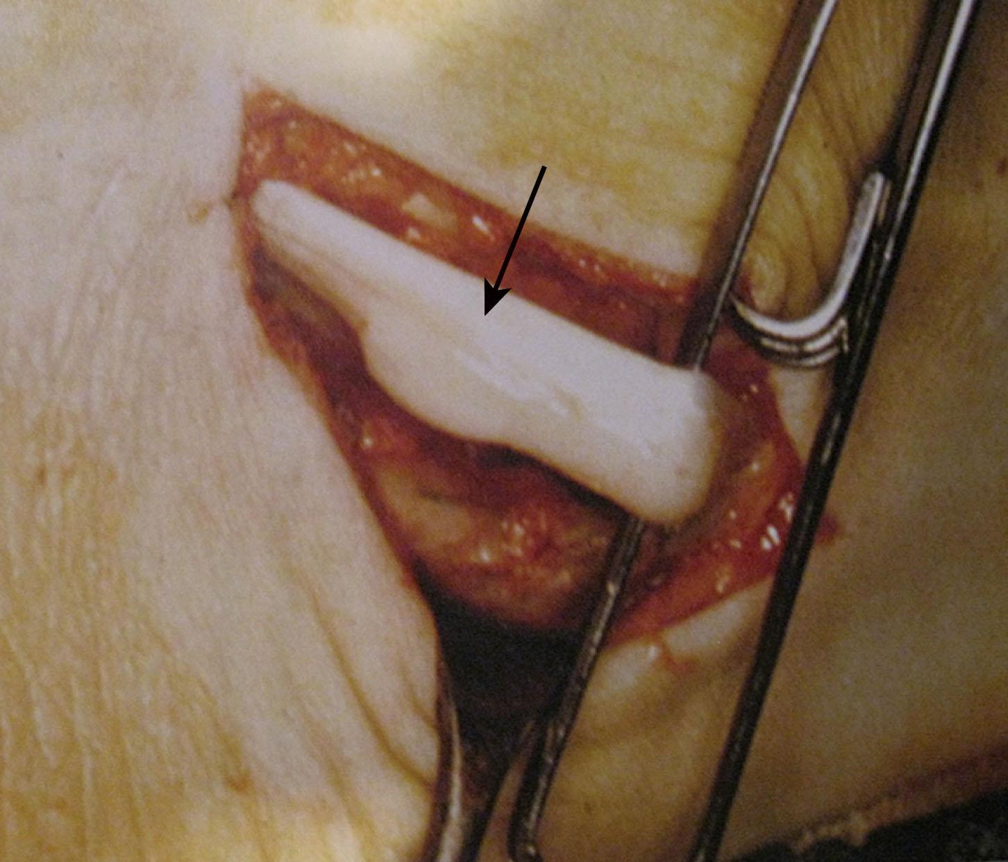 Fig. 28-38, Nodule on the flexor hallucis tendon causing triggering of the hallux (arrow) .