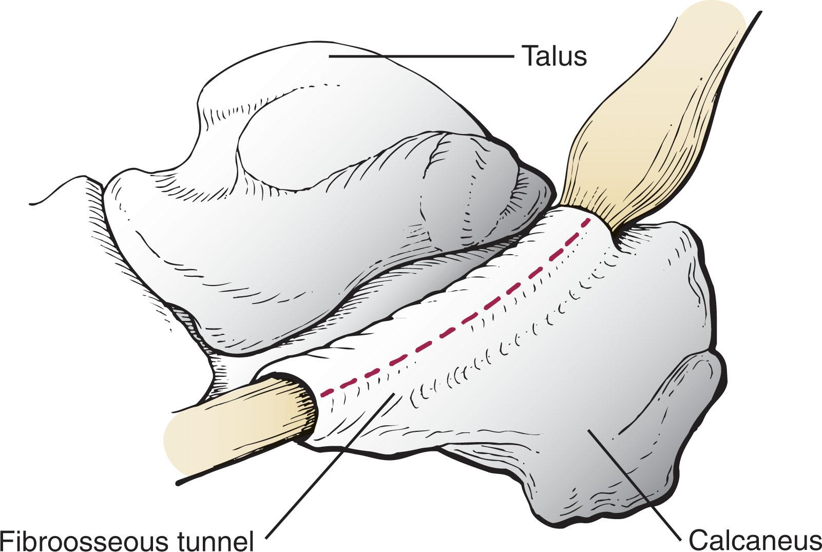 Fig. 28-39, The flexor hallucis longus can be triggered from nodularity or tendon thickening with restricted motion in the fibroosseous tunnel.