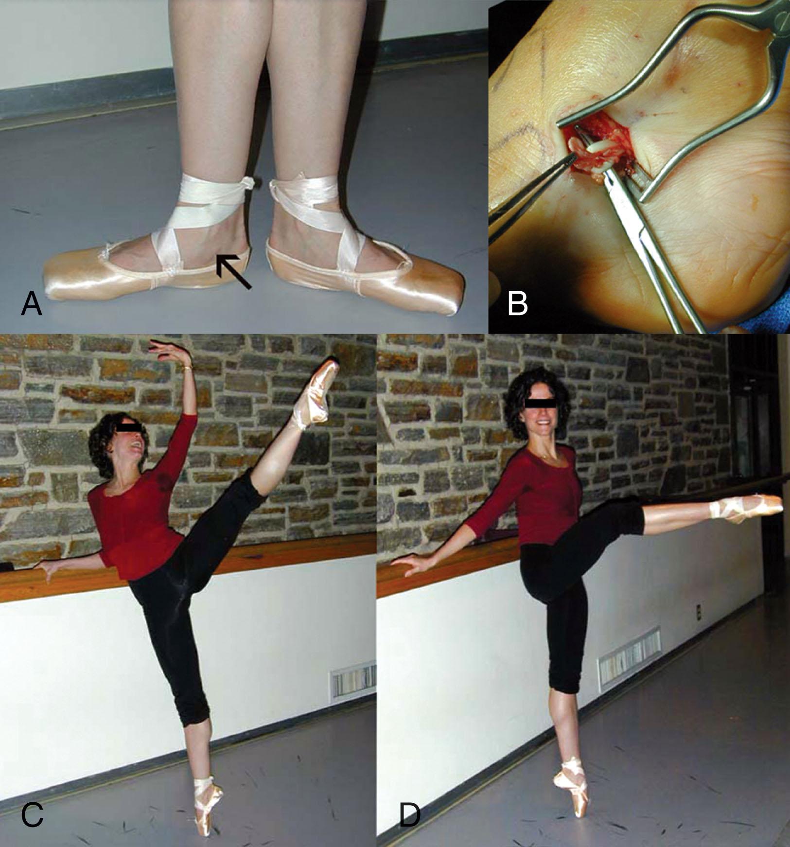 Fig. 28-40, Flexor hallucis longus (FHL) tenosynovitis in a professional dancer. A , Preoperative swelling of the tendon sheath with a painful limited range of motion of the ankle and great toe. B , Intraoperative photograph of tendon sheath release. A flap tear of the tendon is identified and resected. Successful return to dancing with full power in the FHL to permit weight-bearing pointe work (C) and ability to perform flexion and extension without triggering, weakness, or pain (D) .