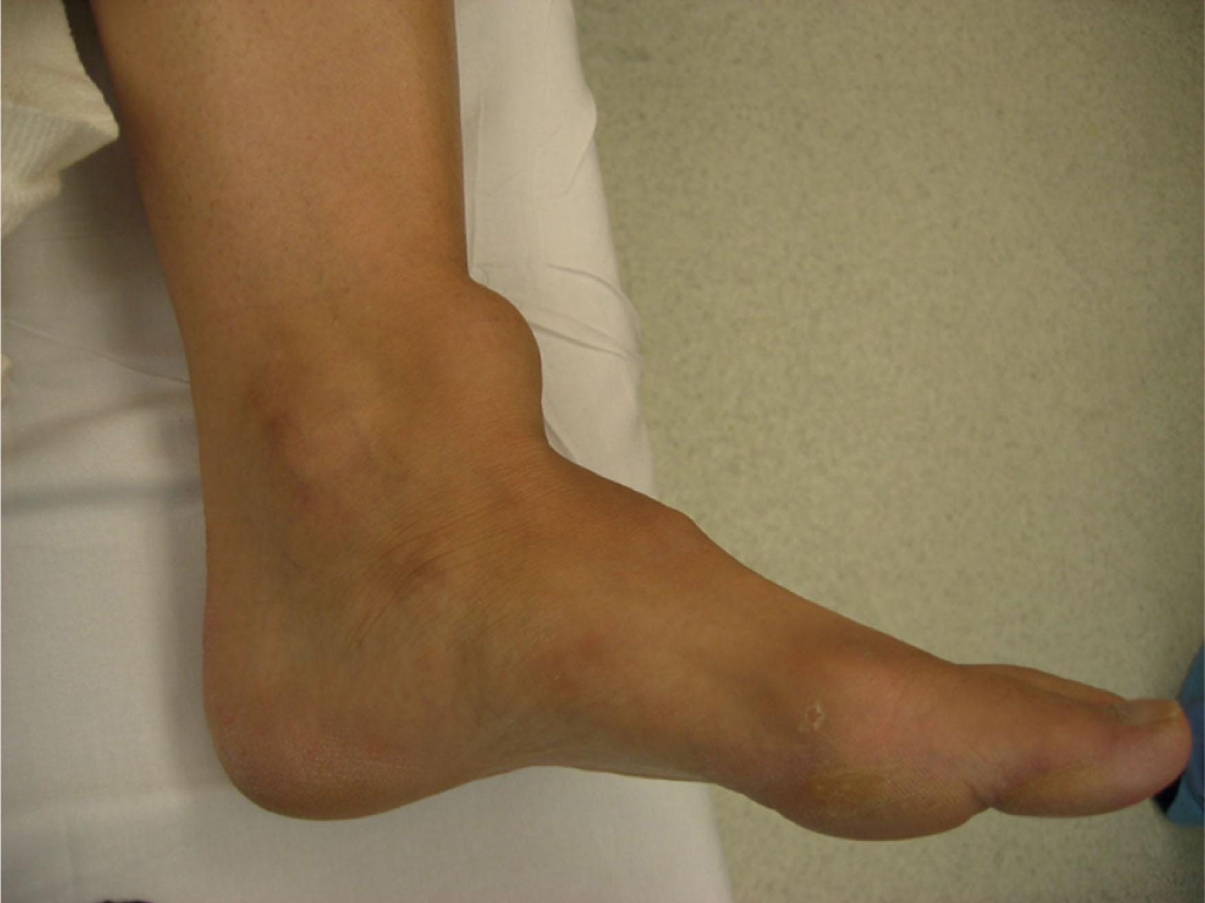 Fig. 28-4, Rupture of anterior tibial tendon can manifest with a lump on the anterior aspect of the ankle region.