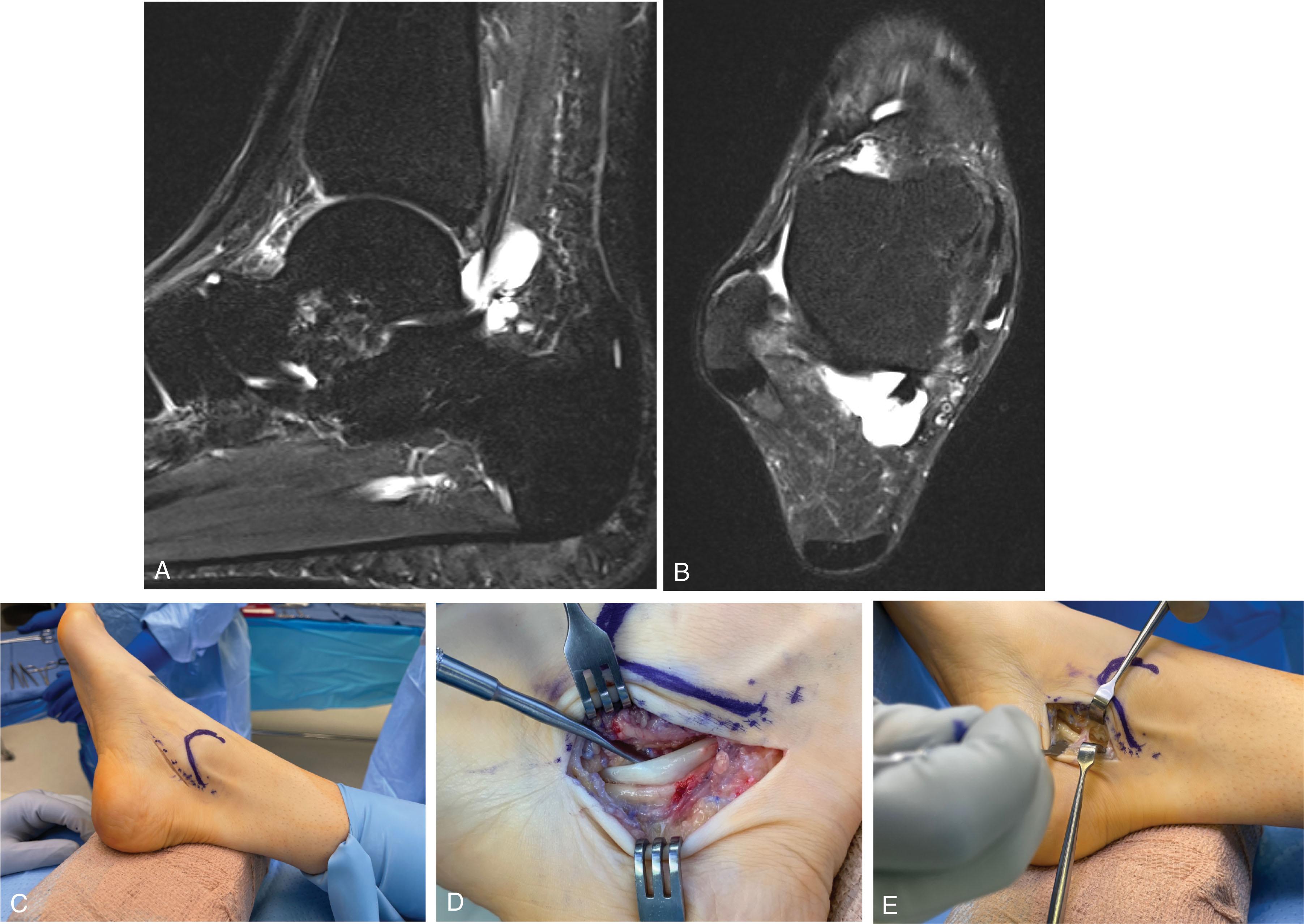 Fig. 28-41, Flexor hallucis longus (FHL) tenosynovitis. A and B , This patient had MR findings consistent with FHL tendinitis and posterior ankle pain exacerbated by passive dorsiflexion of the toe. C , The surgical approach is posterior to the medial malleolus. The FHL tendon sheath can be identified distally in the wound with care to avoid injury to the neurovascular structures as the dissection is carried proximally. D , The tendon was noted to have an inflammatory nodule with thickening proximal to the divided fibroosseus tunnel that resulted in entrapment at the tunnel entrance. E , The fibroosseus tunnel is fully released.