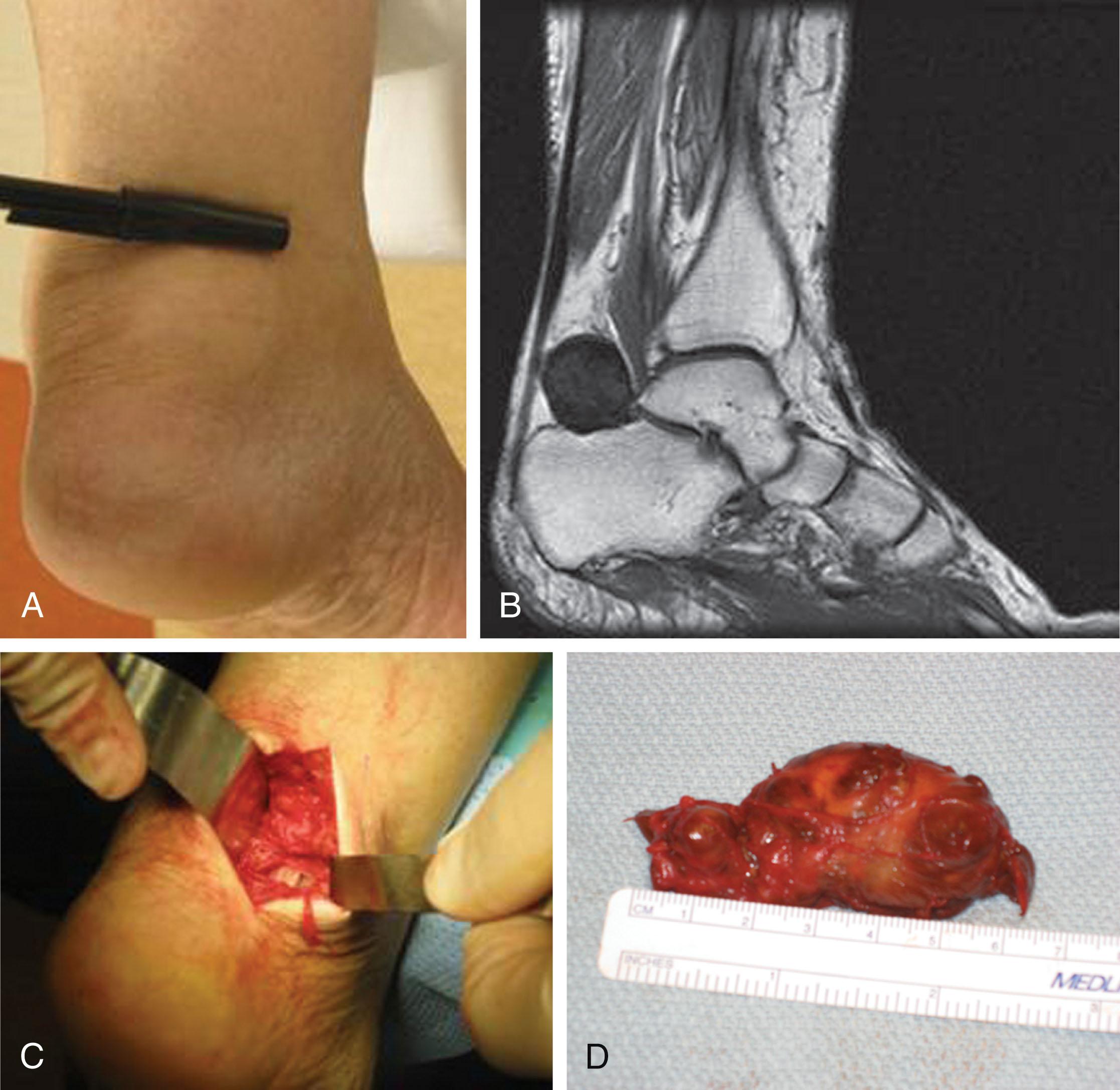 Fig. 28-42, Giant cell tumor of flexor hallucis longus tendon sheath. A , Clinical presentation of soft tissue mass. B , Magnetic resonance image displaying mass on posterior aspect of the medial ankle joint. C , Intraoperative photograph of resection of tumor. D , Resected specimen demonstrating large giant cell tumor.