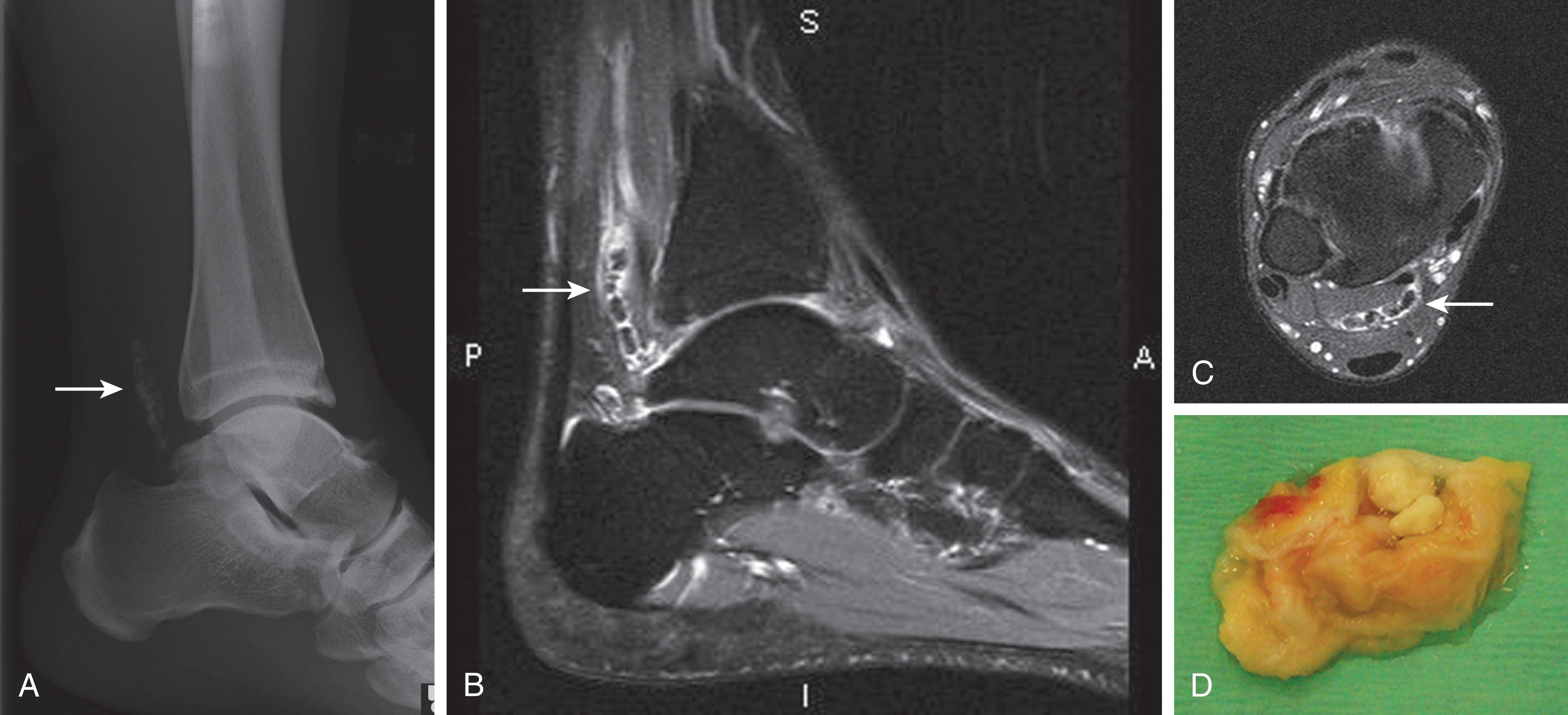 Fig. 28-43, Tenosynovial osteochondromatosis of the flexor hallucis longus tendon. A , Lateral radiograph of osteochondromal lesions ( arrow ). B , Fat-suppressed magnetic resonance image demonstrating multiple calcific nodules ( arrow ). C , Axial image showing multiple calcific nodules ( arrow ). D , Excised specimen containing multiple osteochondromatous nodules. ( A – C , From Oakley J, Yewlett A, Makwana N: Tenosynovial osteochondromatosis of the flexor hallucis longus tendon, Foot Ankle Surg 16:148–150, 2010. Used with permission. D , Courtesy J. Oakley, MRCS Ed, MBBCH, Shropshire, United Kingdom.)