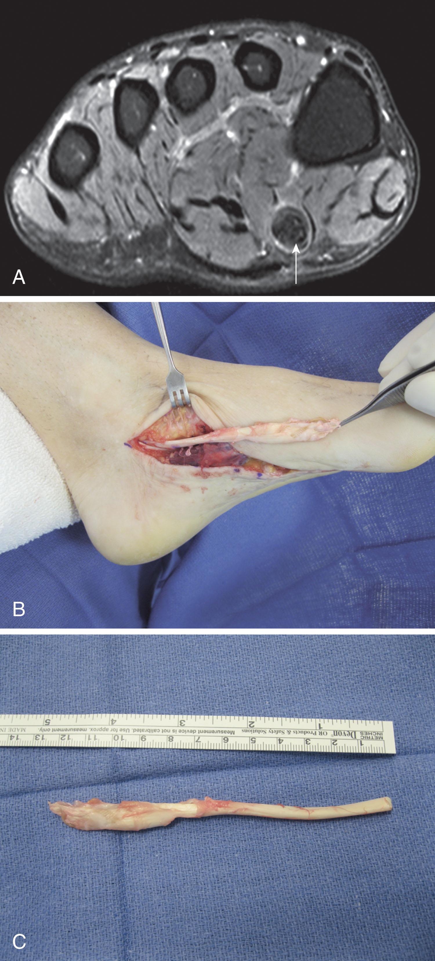 Fig. 28-44, Tendinosis of the distal flexor hallucis longus (FHL) tendon. A , Coronal magnetic resonance image demonstrating marked tendinosis of the FHL tendon. B , Operative exposure demonstrating tendinosis of the distal FHL. C , Excised segment distal to the fibroosseous tunnel, with marked tendinosis.