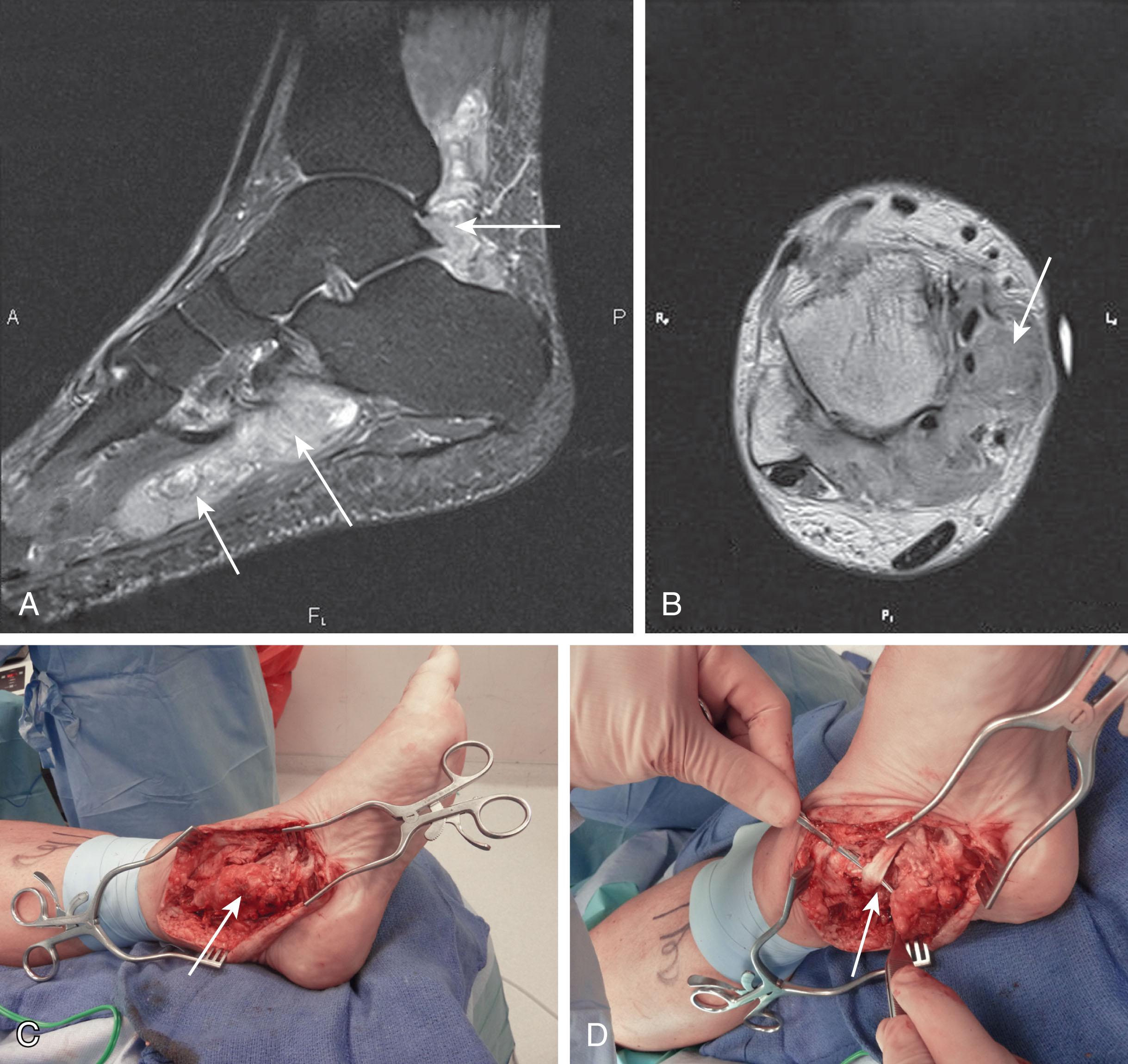 Fig. 28-45, Pigmented villinodular synovitis of the flexor hallucis longus (FHL) tendon. Sagittal (A) and axial plane (B) magnetic resonance images demonstrating soft tissue mass (arrows) encompassing the FHL tendon. C , Operative exposure of the mass (arrow) . D , After excision of mass (arrow) and debridement of the FHL tendon.