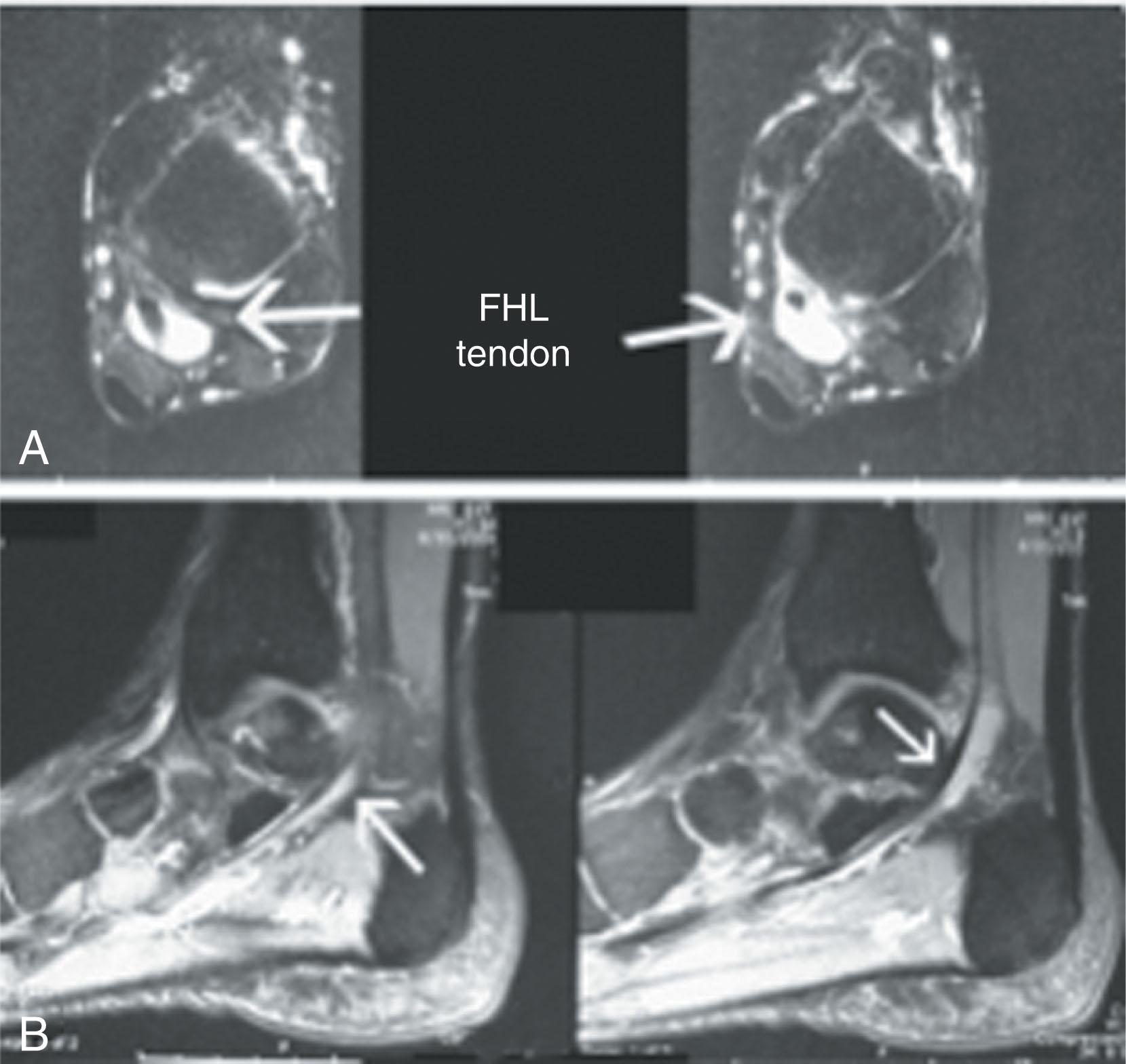 Fig. 28-46, T2-weighted magnetic resonance images 5 months after an incomplete tear of the flexor hallucis longus (FHL). A , Axial views demonstrate flexor tenosynovitis with increased signal intensity and abnormal but intact FHL tendon. B , Sagittal view demonstrates course of tendon with tenosynovitis behind the ankle and under the sustentaculum talus.