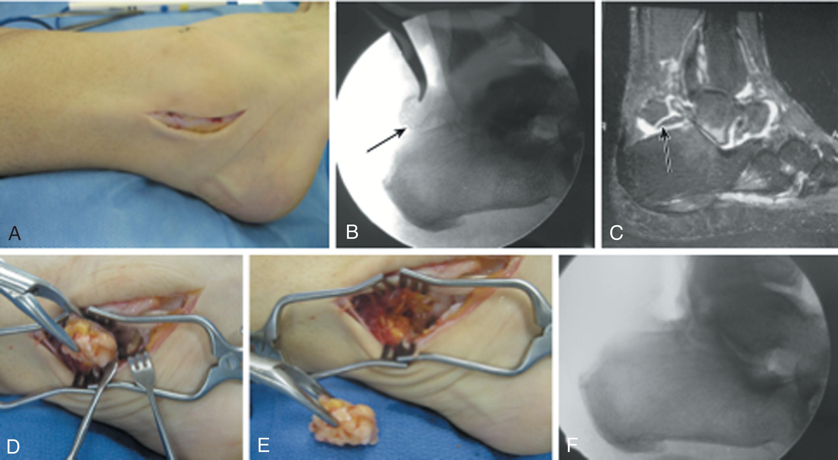 Fig. 28-48, Excision of os trigonum from lateral approach. A , Lateral incision. Lateral radiograph (B) and sagittal (C) magnetic resonance images demonstrating large os trigonum (arrows) . D and E , Operative removal of os trigonum. F , Final lateral radiograph after removal.