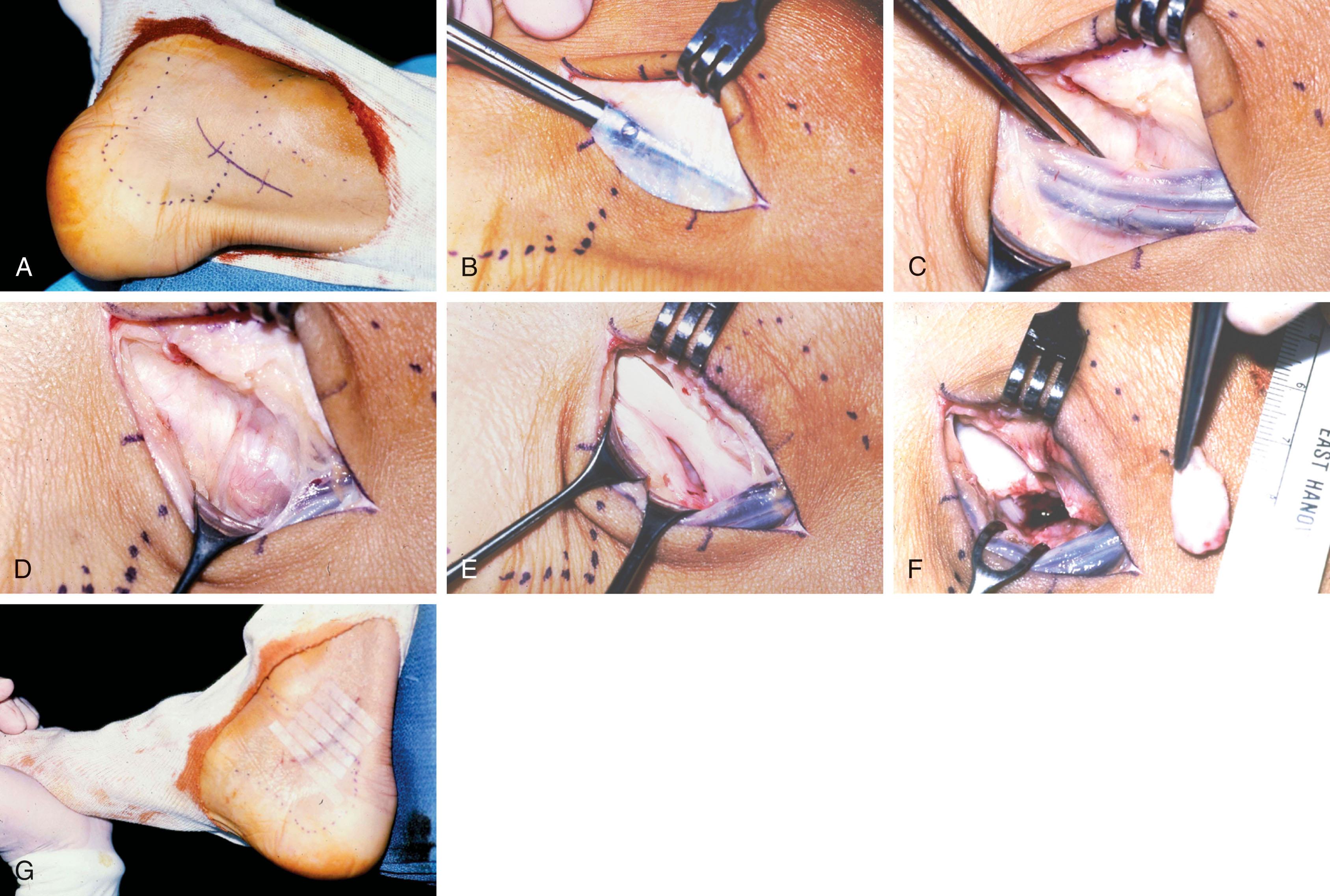 Fig. 28-49, A , Posteromedial incision. B , Division of the laciniate ligament. C , Exposing the neurovascular bundle. D , The underlying flexor hallucis longus (FHL) tendon. E , Tenolysis of the FHL tendon. F , Removal of the adjacent trigonal process. G , Closure of the wound in neutral dorsiflexion.