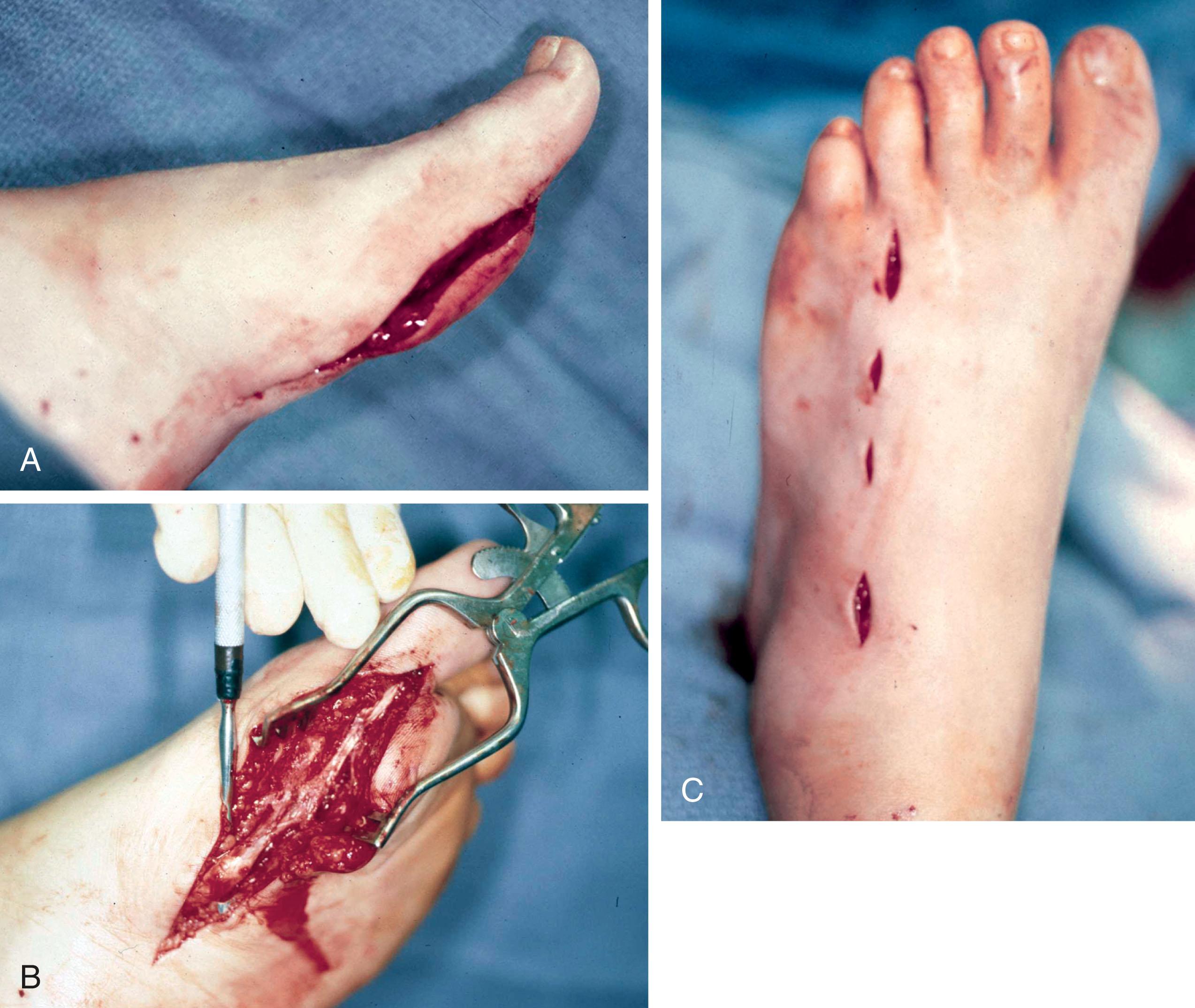 Fig. 28-50, Distal rupture of the flexor hallucis longus (FHL) treated with extensor digitorum brevis (EDB) free graft transfer. A , The patient underwent bunion surgery, which resulted in progressive weakness of the FHL. Once she could no longer flex her great toe, the FHL tendon was approached plantar-medially. B , The FHL was found to be attenuated and fibrotic. C , The fourth-toe EDB was harvested through multiple small incisions and used as a free tendon graft, successfully bridging the gap.