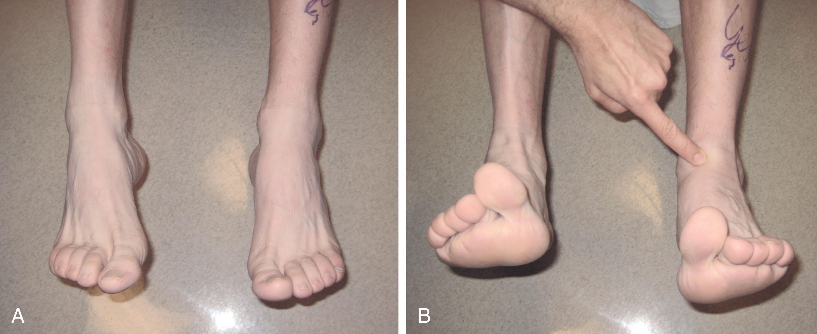 Fig. 28-5, Examination after rupture of the anterior tibial tendon. A , An absence of dorsiflexion power is not seen with the feet in plantar flexion. B , With dorsiflexion, the rupture is obvious with an absence of the anterior tibial tendon on the left.