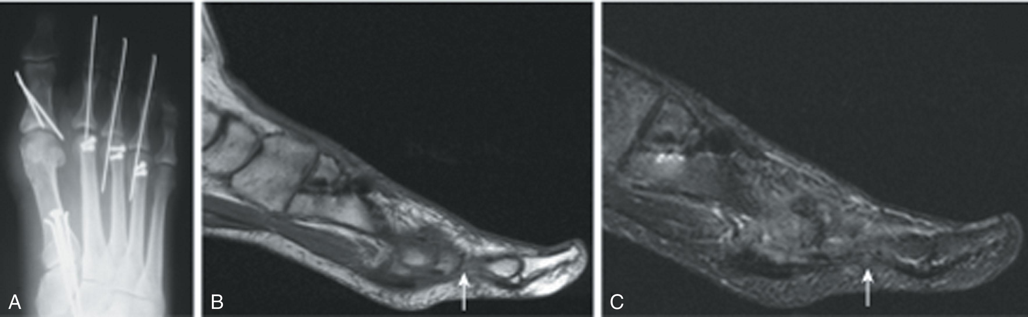 Fig. 28-51, Iatrogenic injury to flexor hallucis longus (FHL) with Akin osteotomy. A , Postoperative radiograph demonstrating Akin osteotomy and bunion correction. B and C , Postoperative magnetic resonance images demonstrating discontinuity of distal FHL in zone 1 (arrows) .